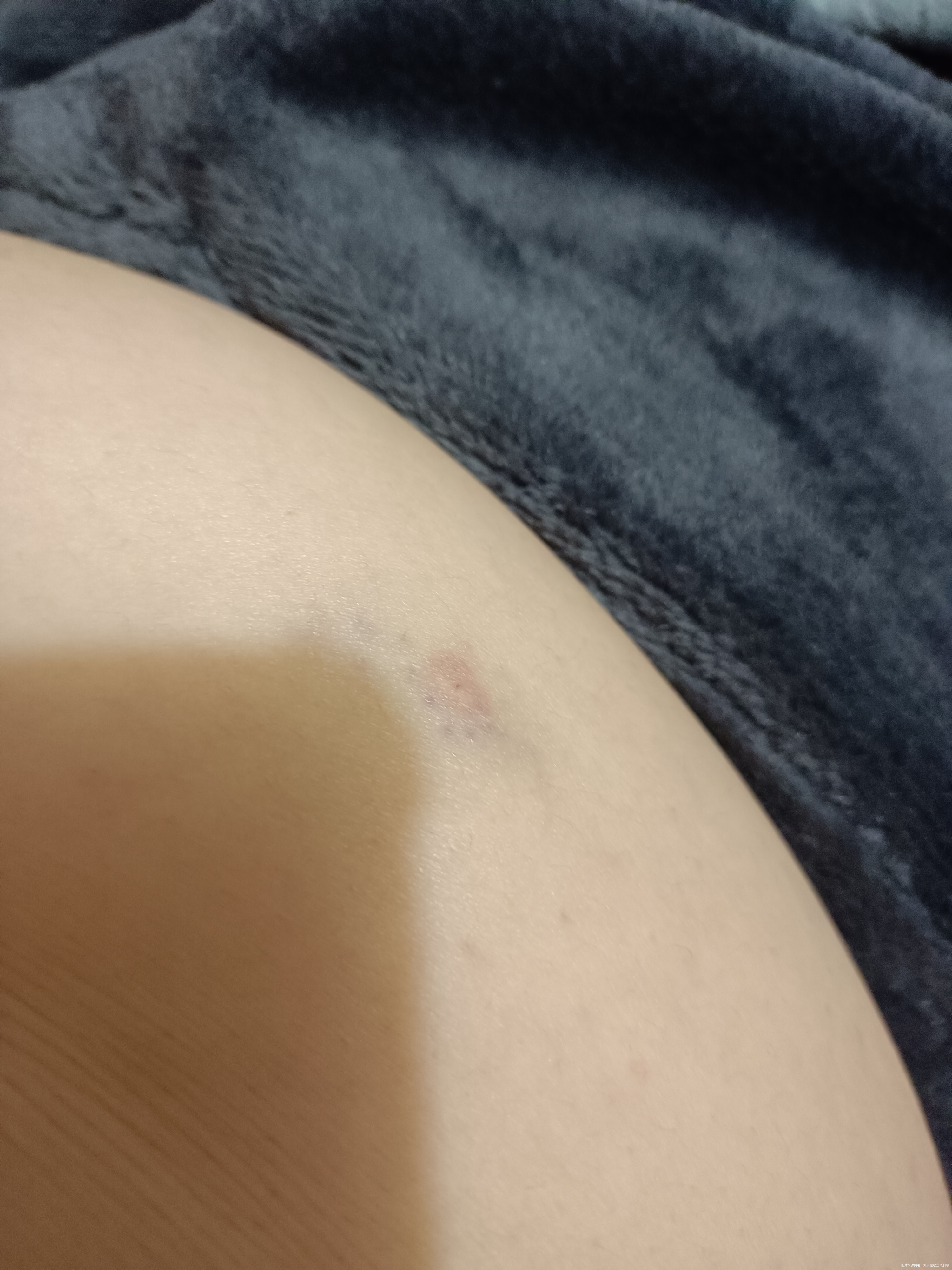 请问刚怀孕打肝素钙打的肚子都一块一块的淤青要