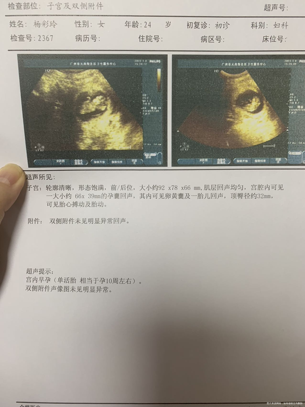 图11229做的阴超26mm图218做的腹部