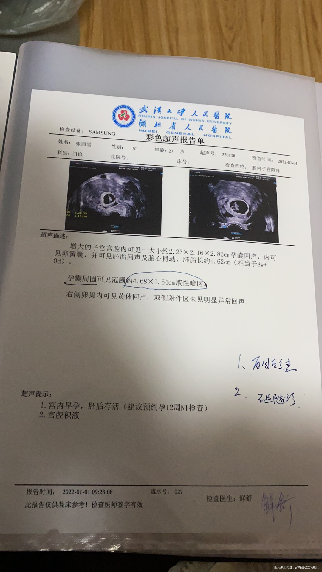 孕早期第八周多两天宫腔积液严重孕酮偏低胎芽胎