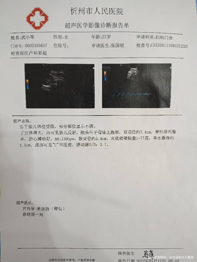 今天整30周脐带绕颈一周还是臀位28周的时候