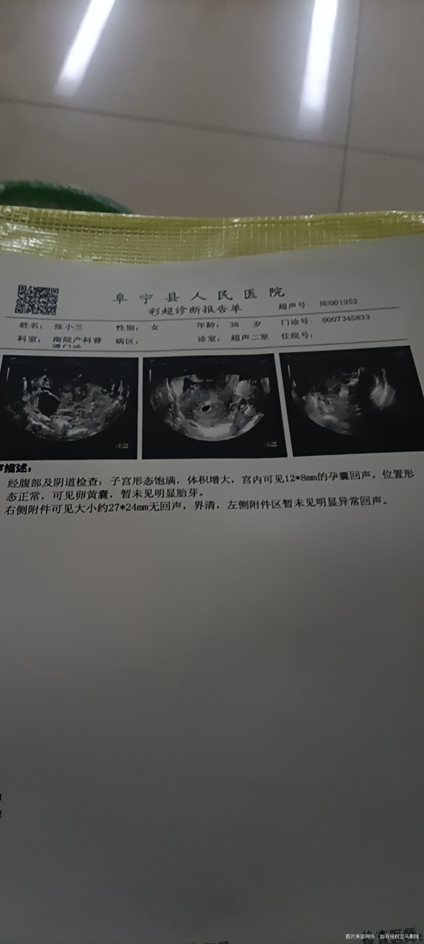 你好想问一下右侧附近可见27✘24无回声是什