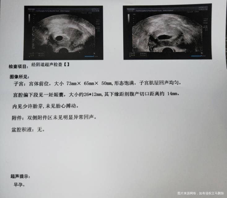 末次12/6日12/18号人授怀孕目前48天