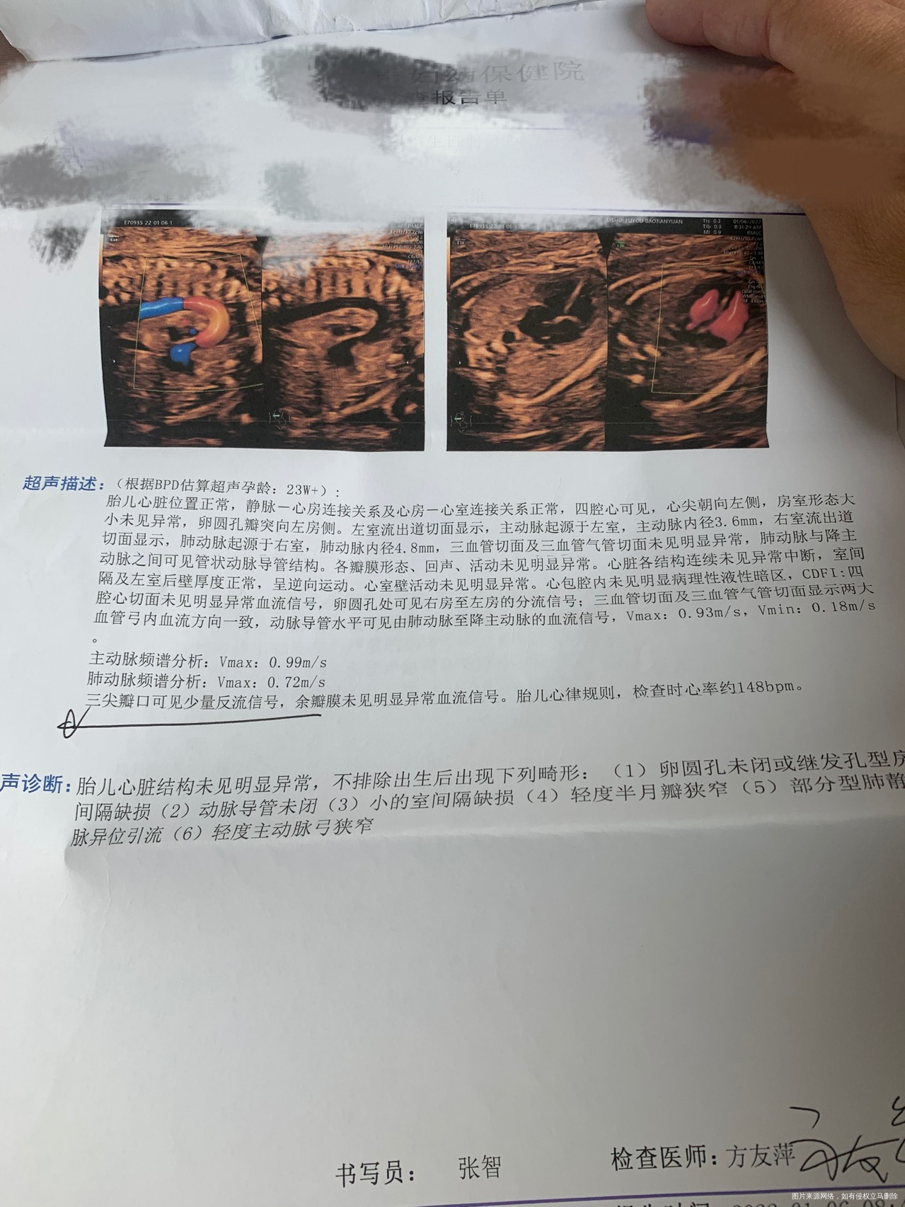 做了胎儿心脏彩超有问题吗
