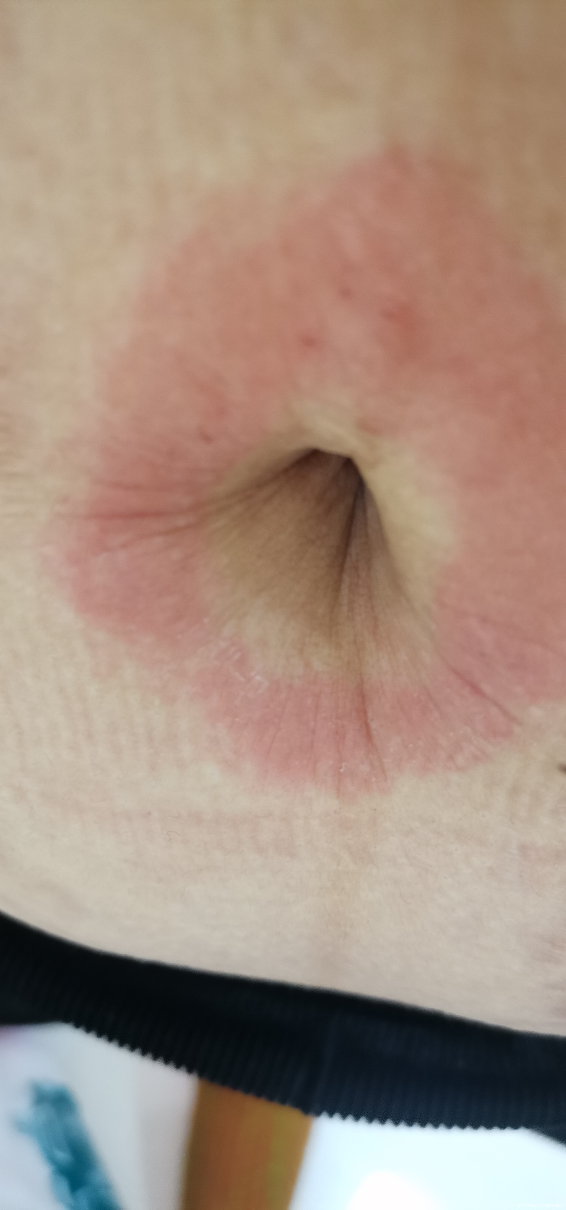 刚刚试纸测出怀孕35天左右肚脐周围过敏痒能抹