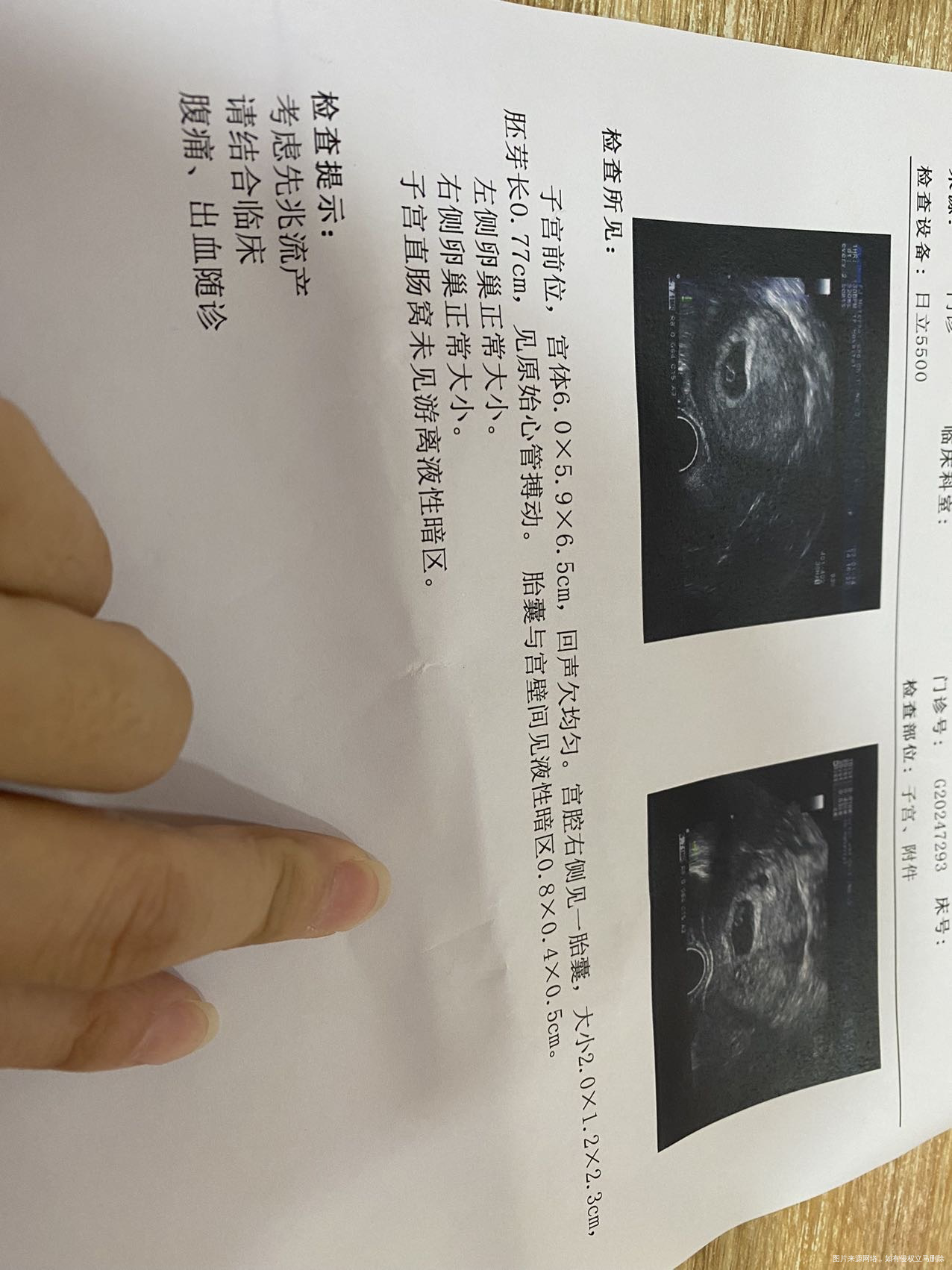 试管一超孕囊在右边会不会后期成宫角孕