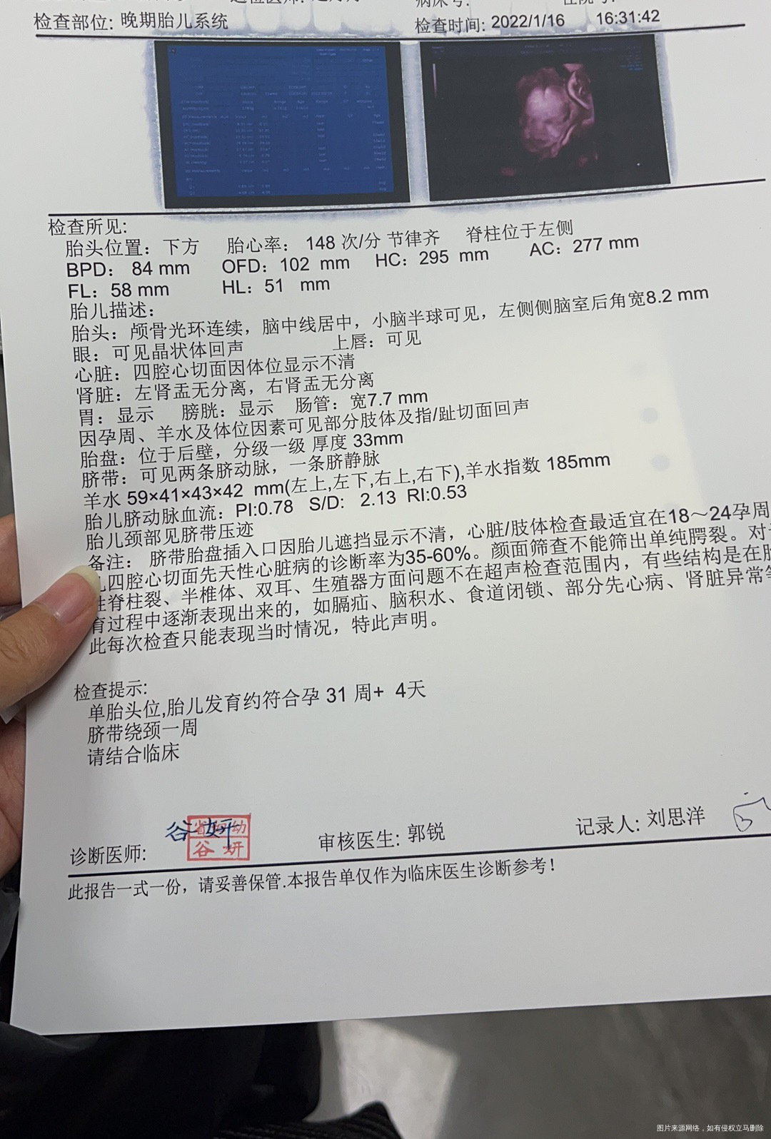 我23周大排畸宝宝侧脑室增宽68mm30周➕