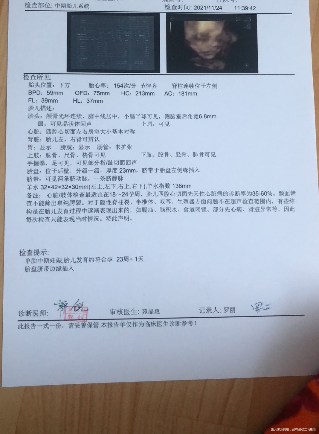 我23周大排畸宝宝侧脑室增宽68mm30周➕