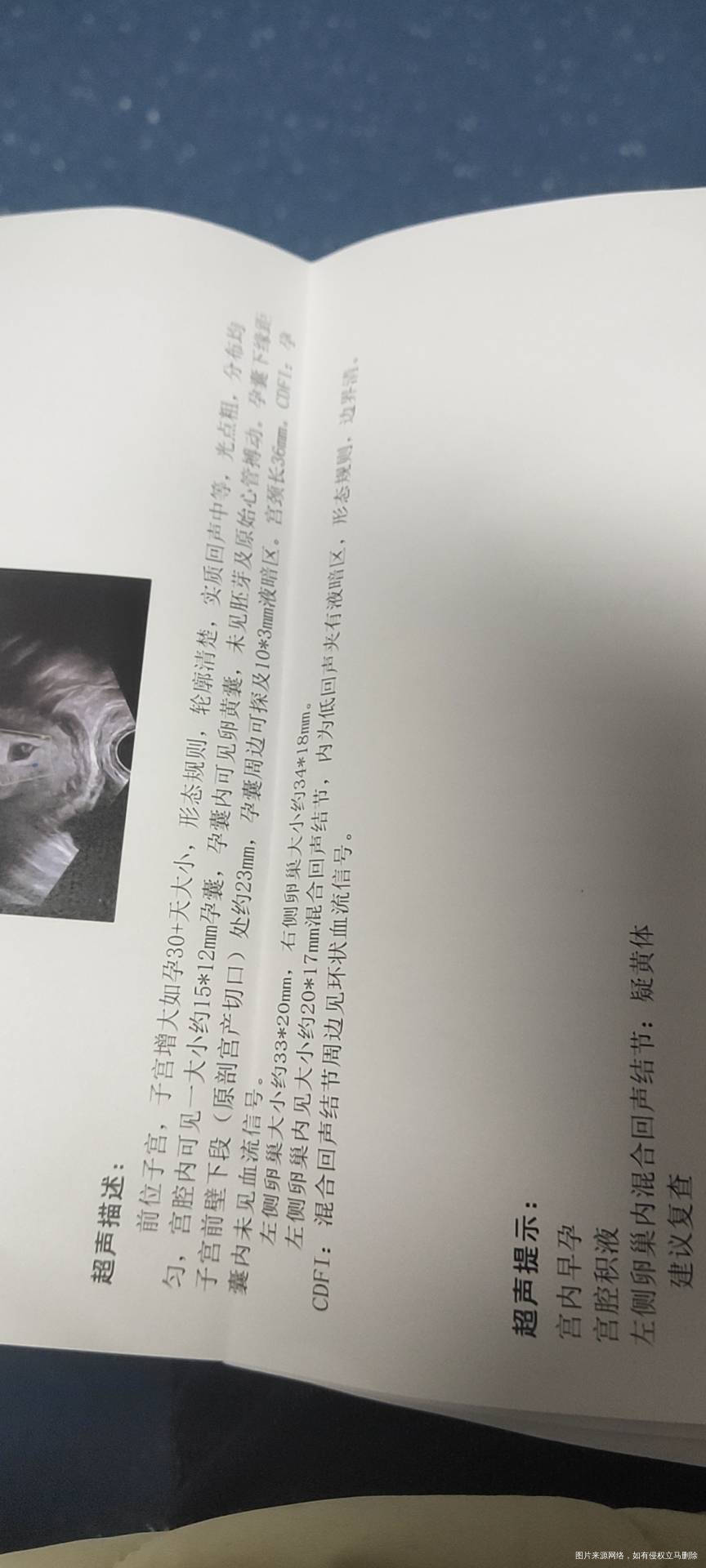 多囊怀孕今天出血医院保胎11号HCG3540