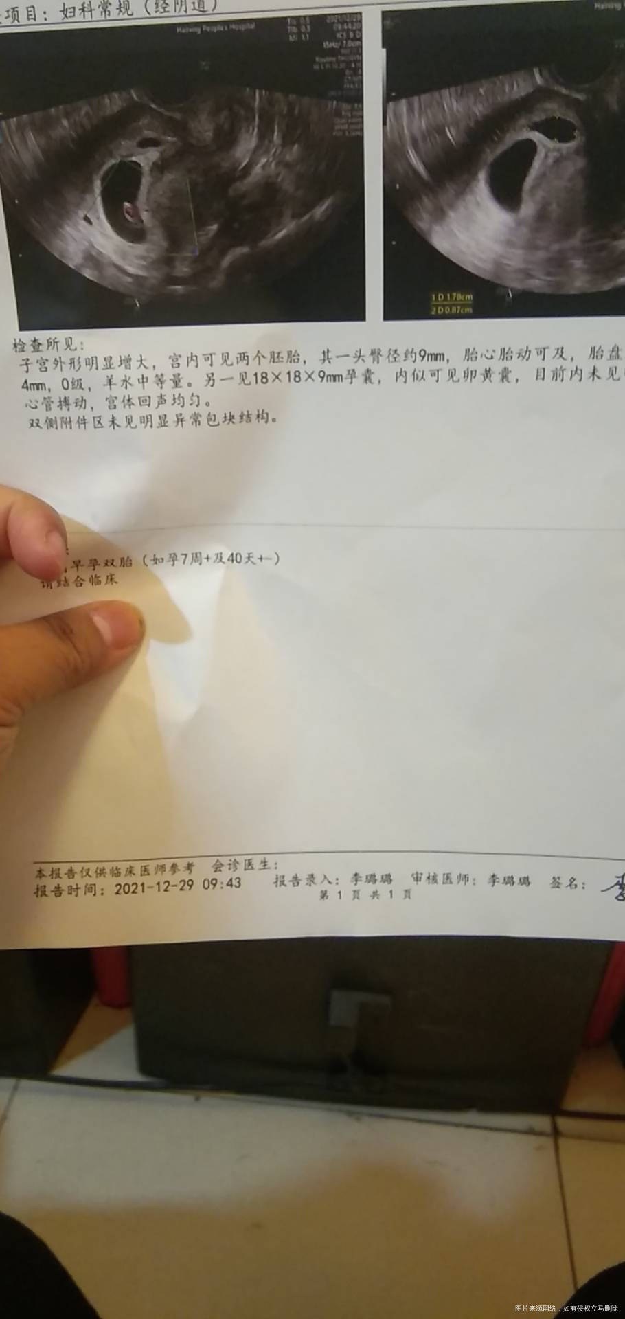 不知道怎么样可影响不小的没胎心胎芽