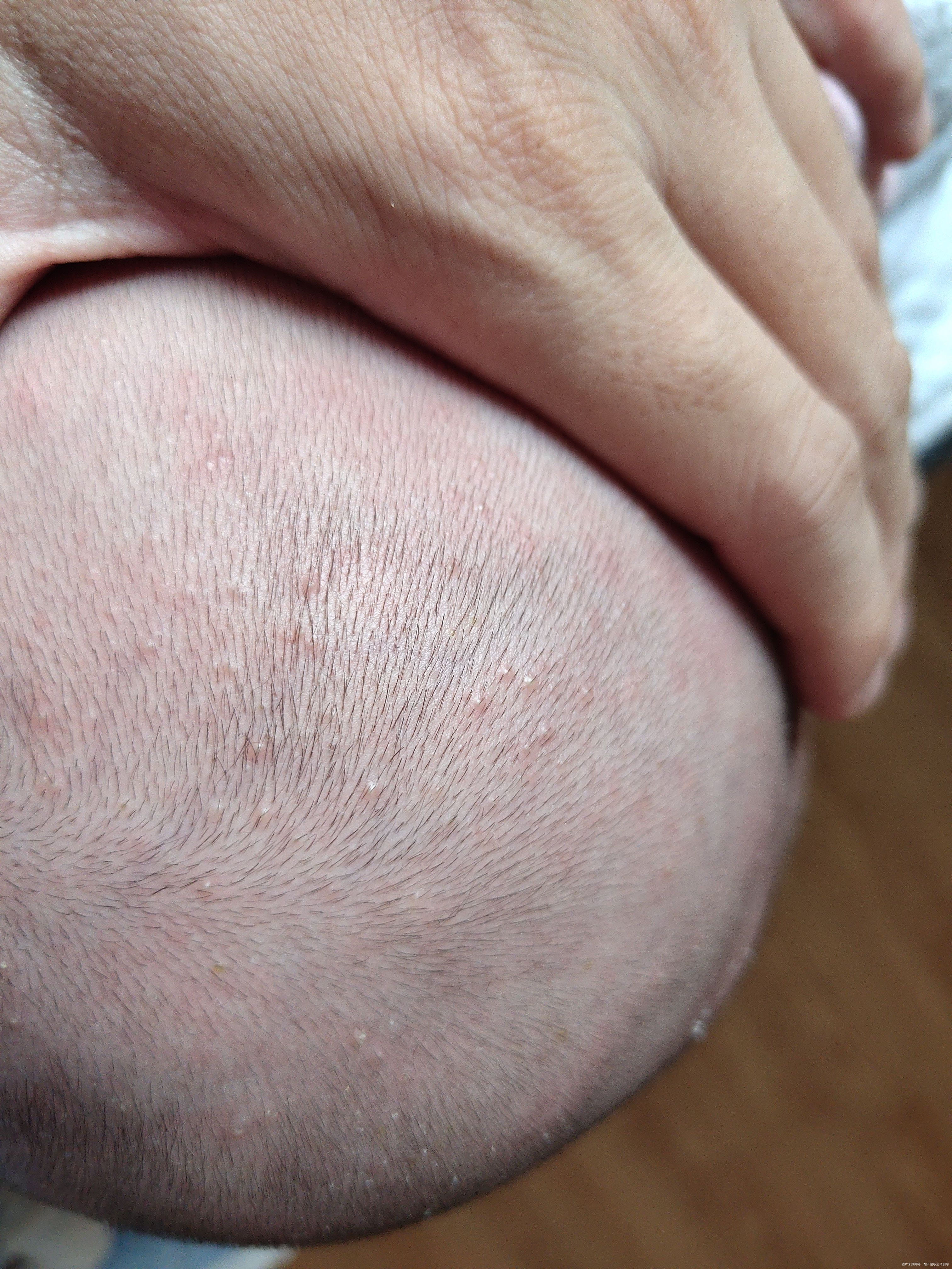 你好这个宝宝头皮上全是是什么有什么去除的