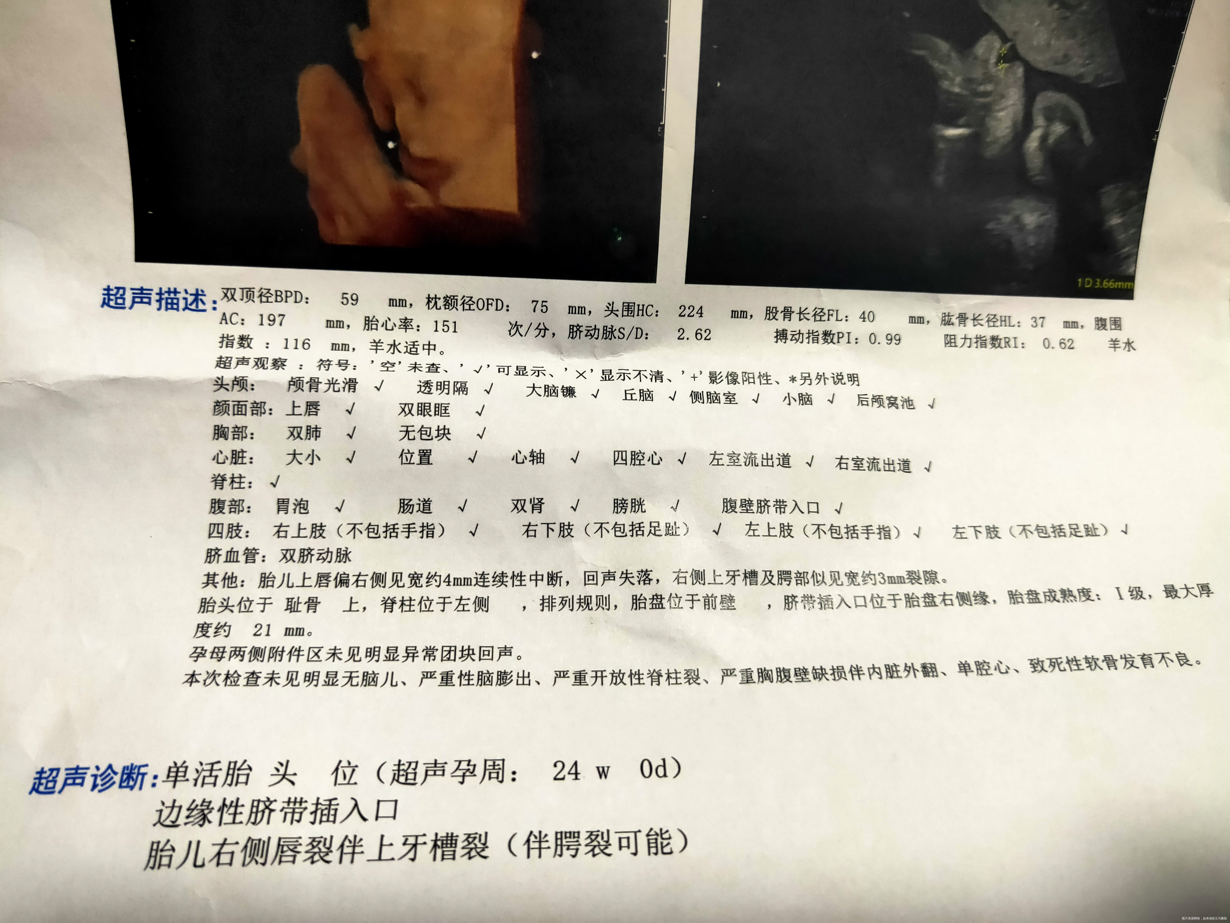 孕24周大排畸显示唇腭裂12周NT正常16周