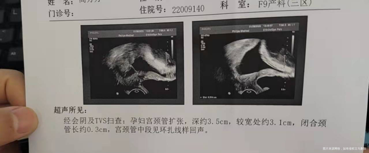 14周环扎的现在怀孕29+4B超显示宫颈管还