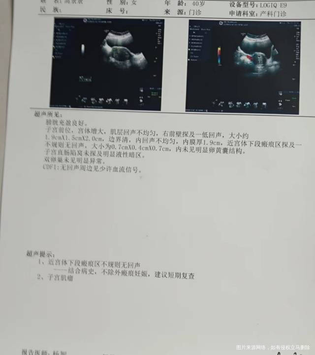 40了拼着命想要个二胎没想到赶上瘢痕妊娠还有