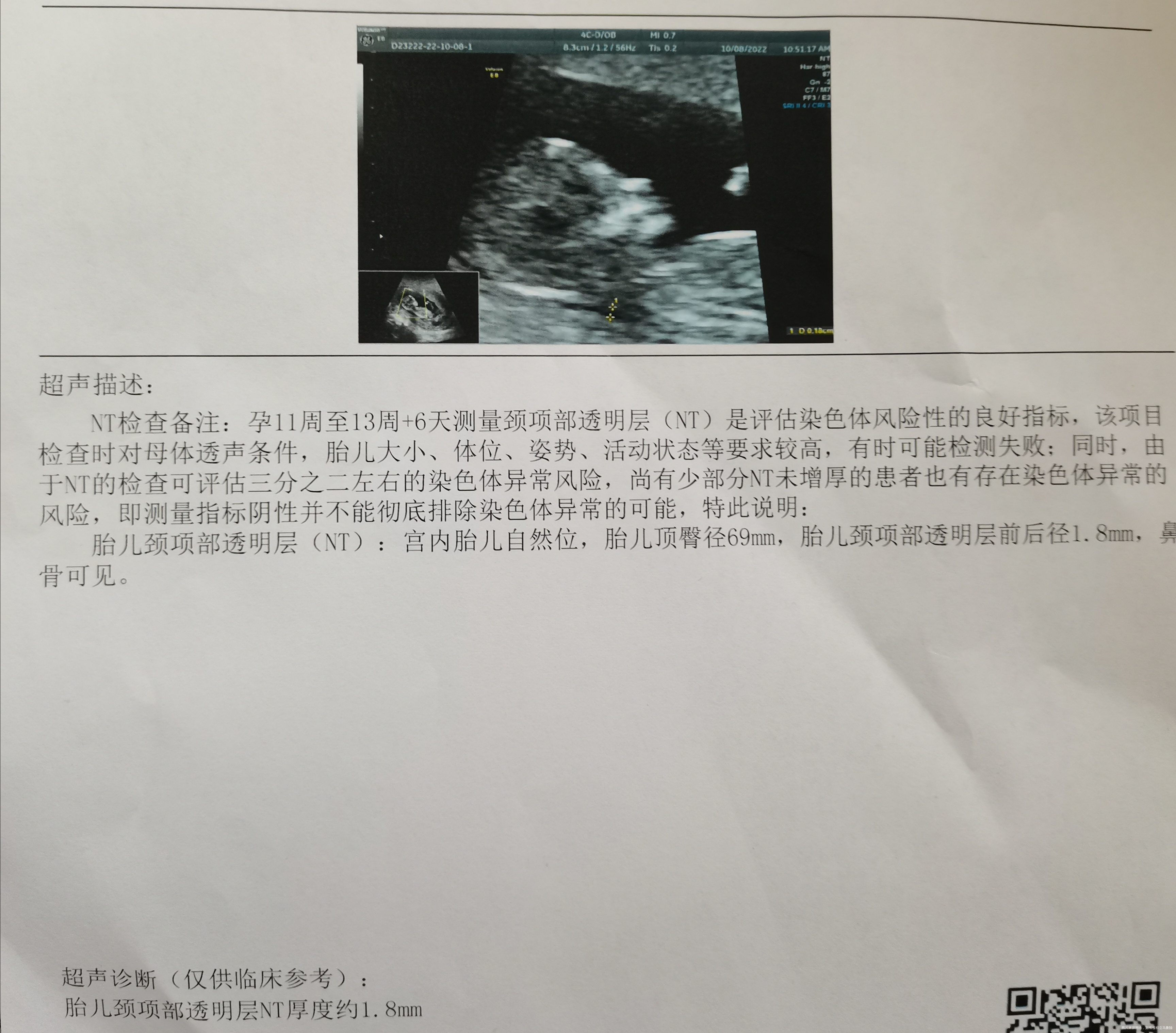 孕12w5dNT检查情况羊水是否正常