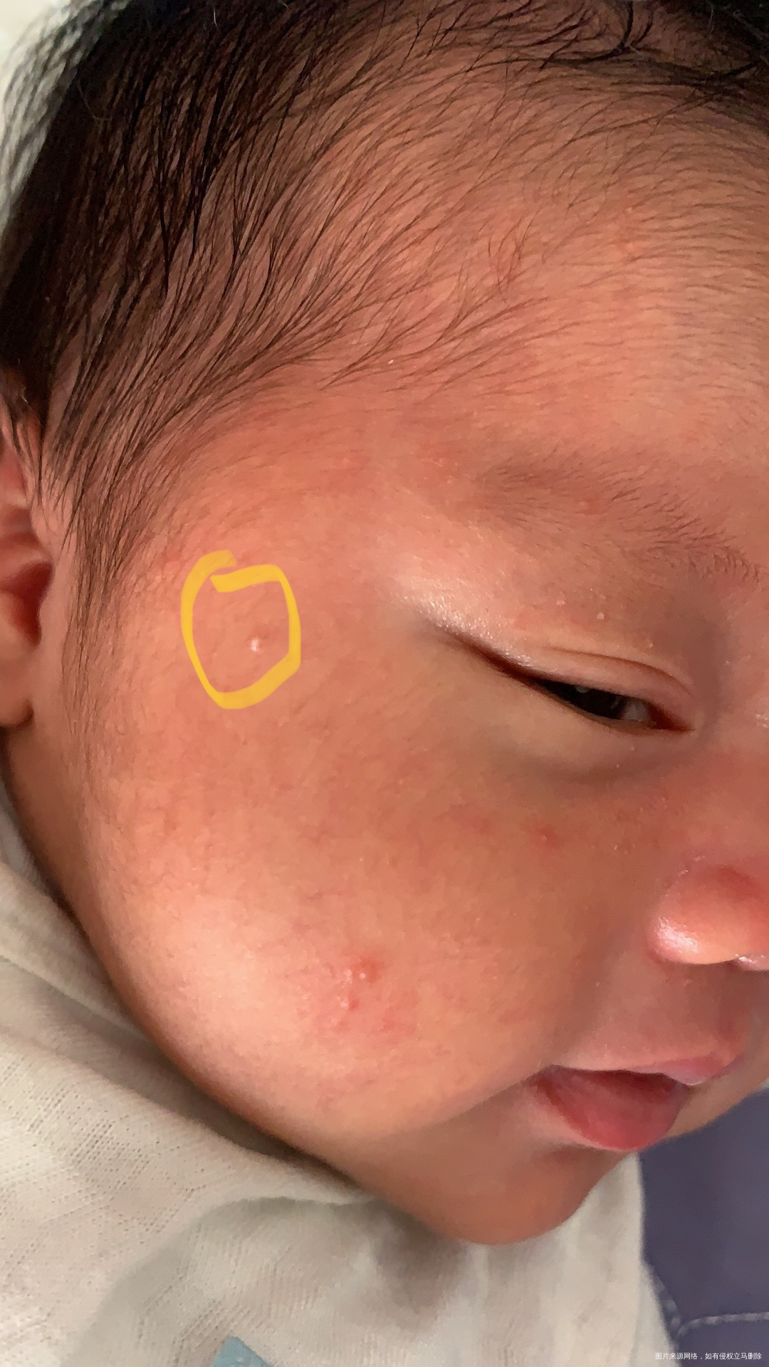 宝宝脸上长一粒一粒的疹子是什么的呢黄色圈起来