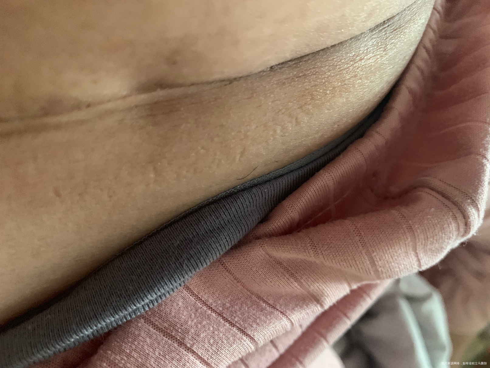 剖腹产14天了伤口还是感觉到痛这是正常现象吗