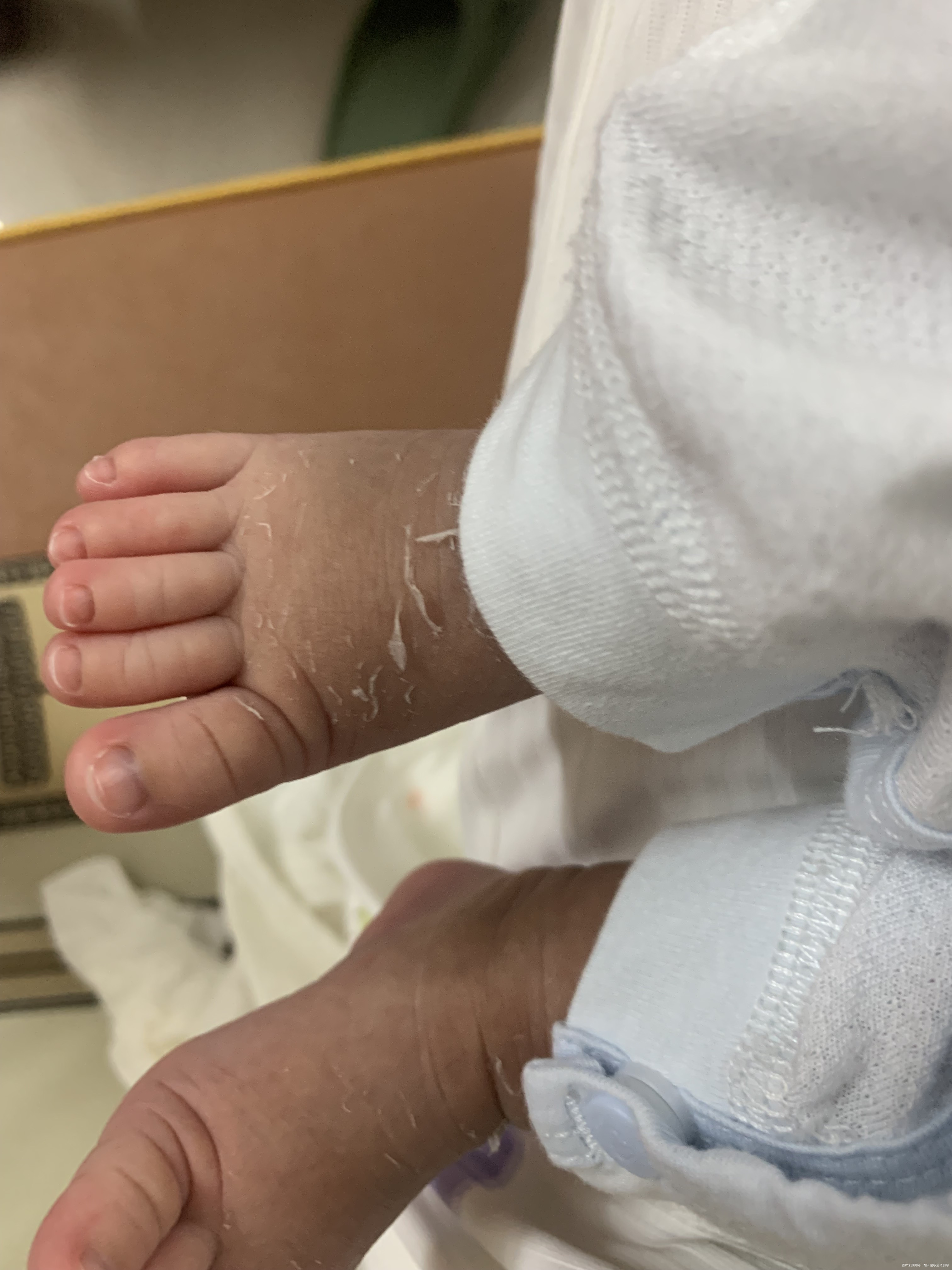 新生儿12天这皮肤是干燥还是自然的皮肤脱落呢