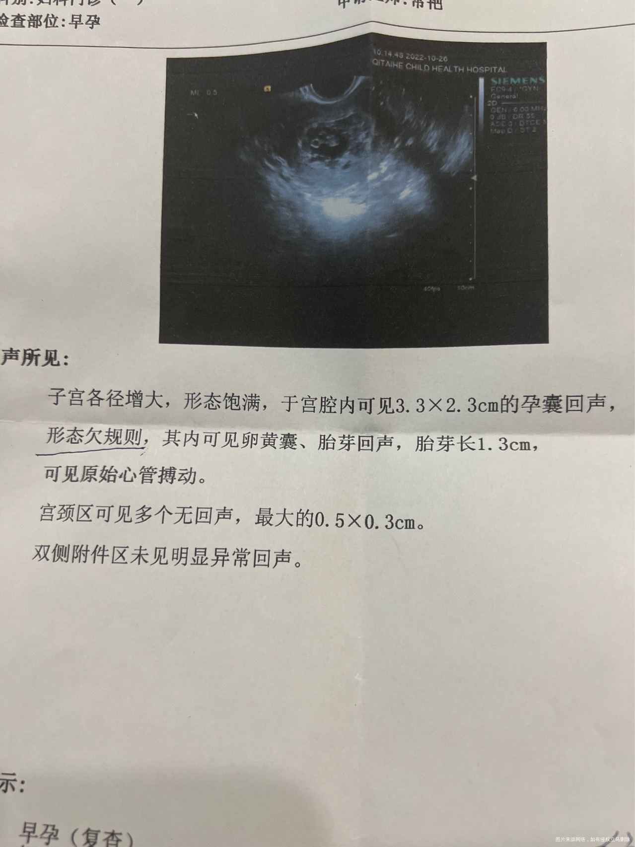 孕7周5天超声检查孕囊形态欠规则需要住院治疗