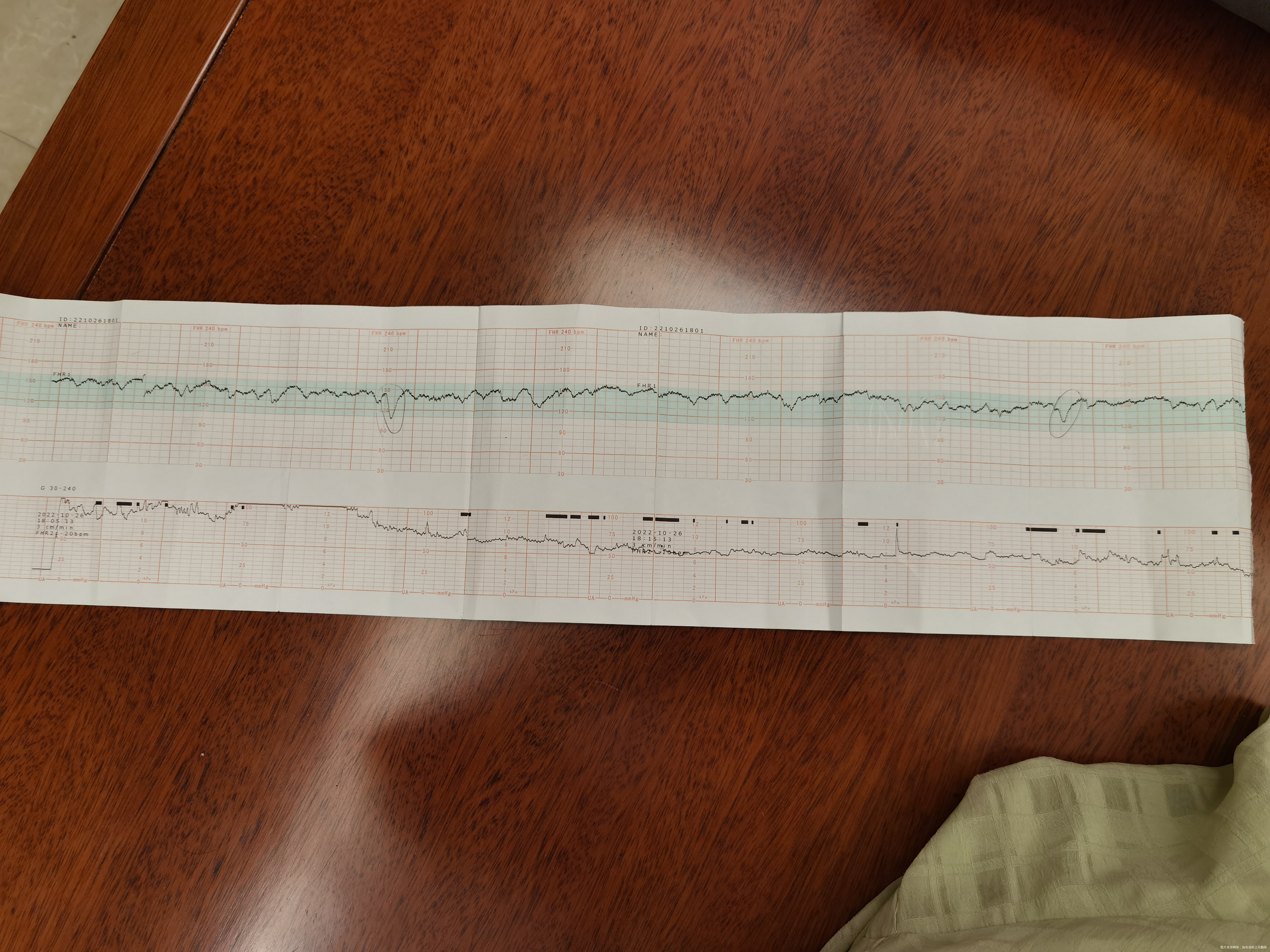 主任您好我今天35周由于这两天胎动减少去医院