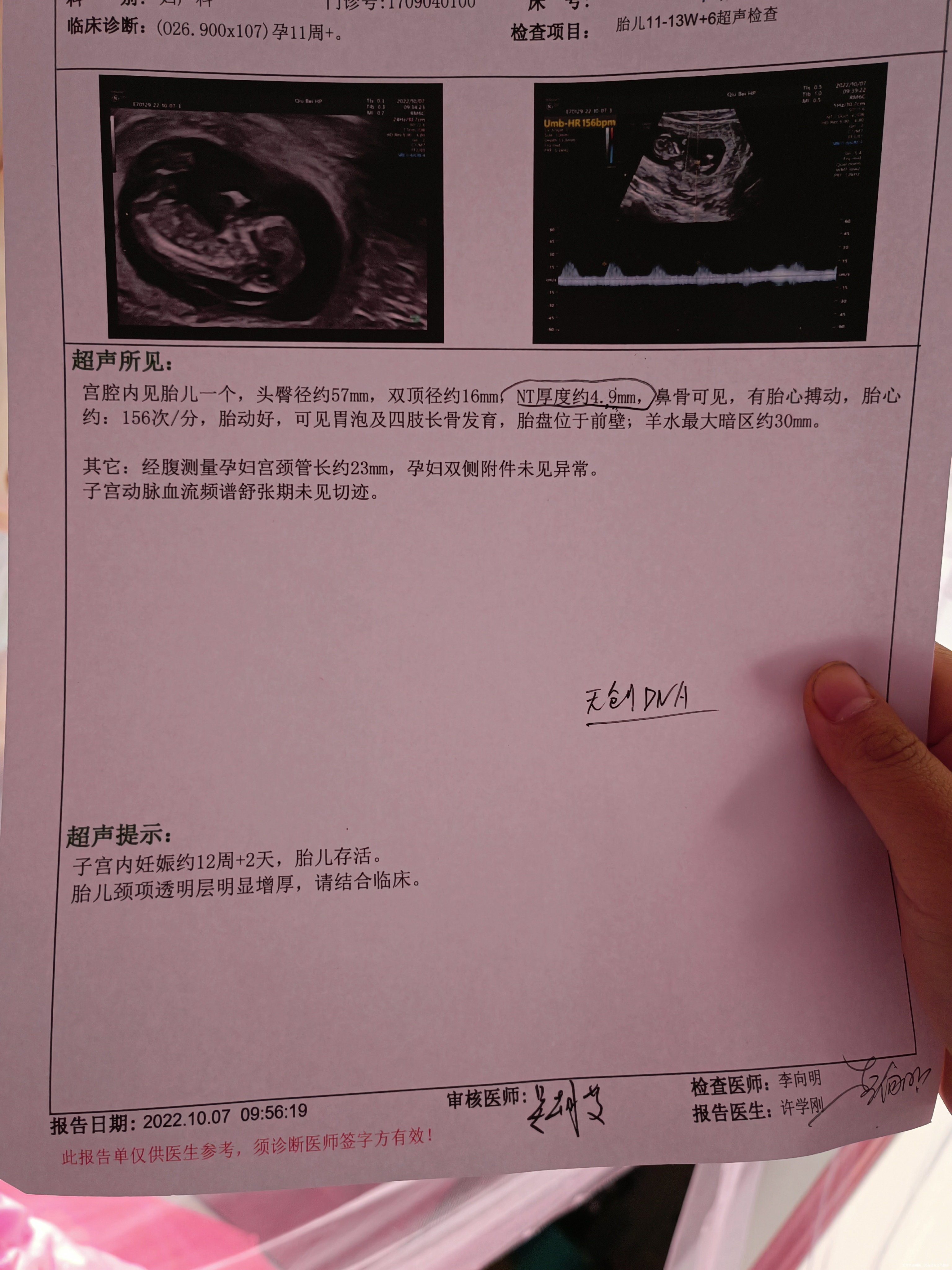 nt值厚绒穿和羊穿那个更准一点不知道要做预约