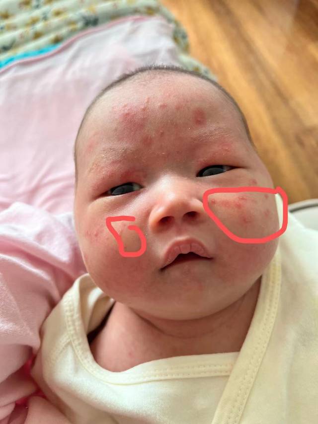 大夫说新生儿痤疮给开了红霉素眼膏可以吗