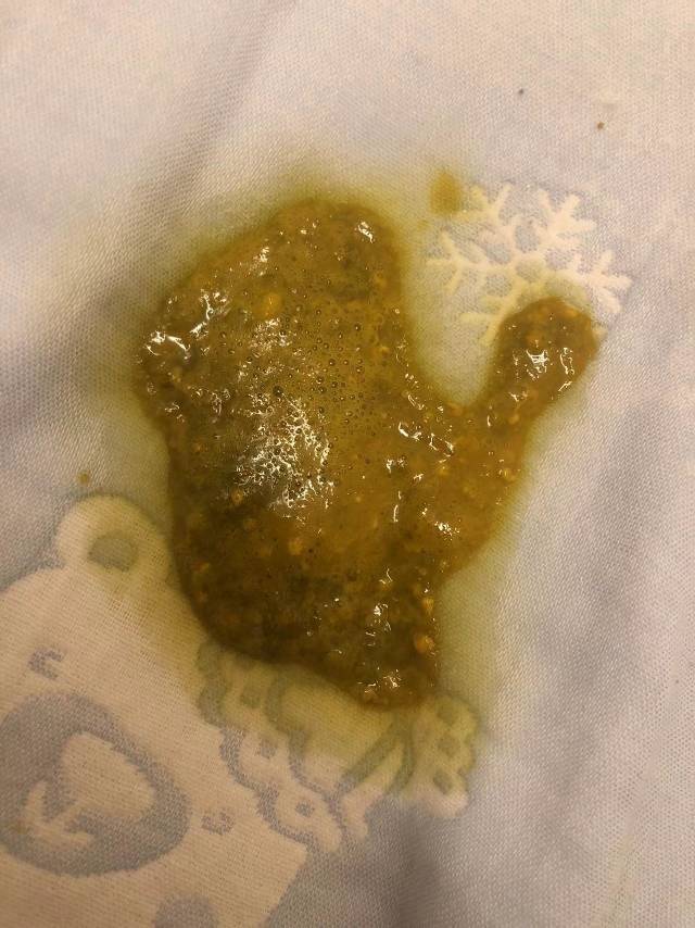 婴儿一直拉酸臭便便有奶瓣和粘液拉稀便便这怎么