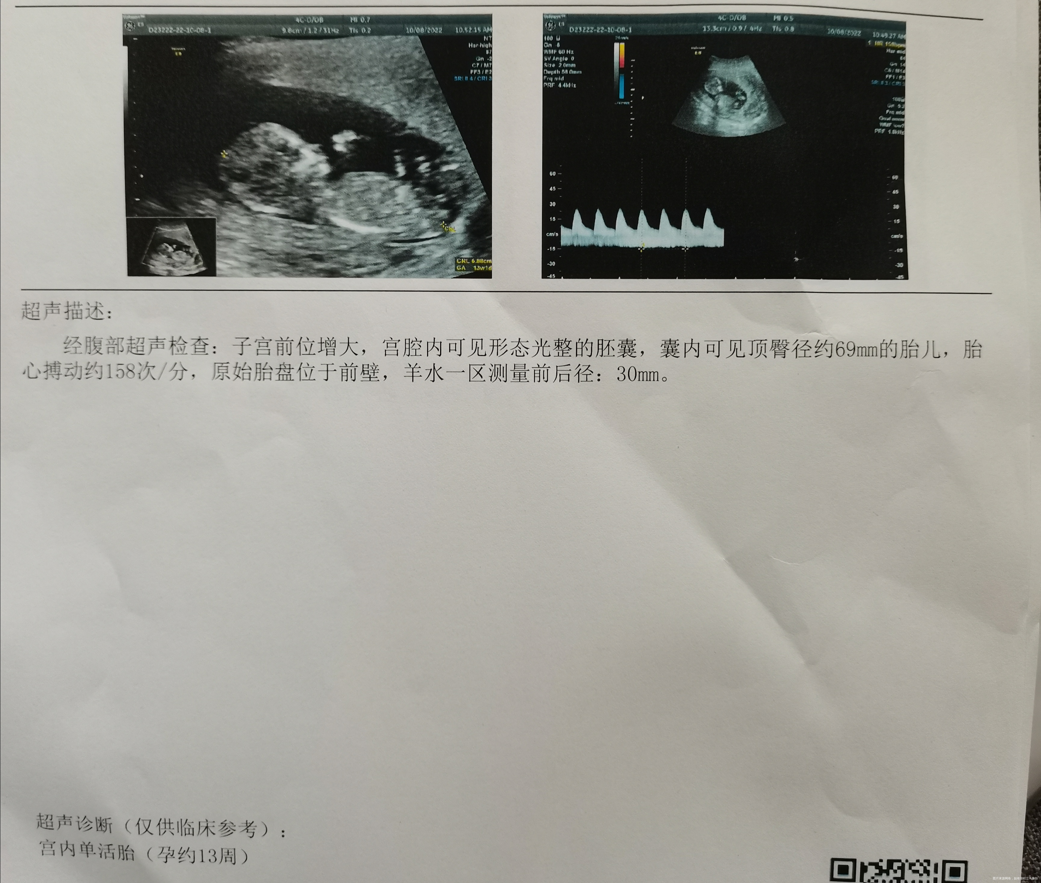 孕12w5dNT检查情况羊水是否正常