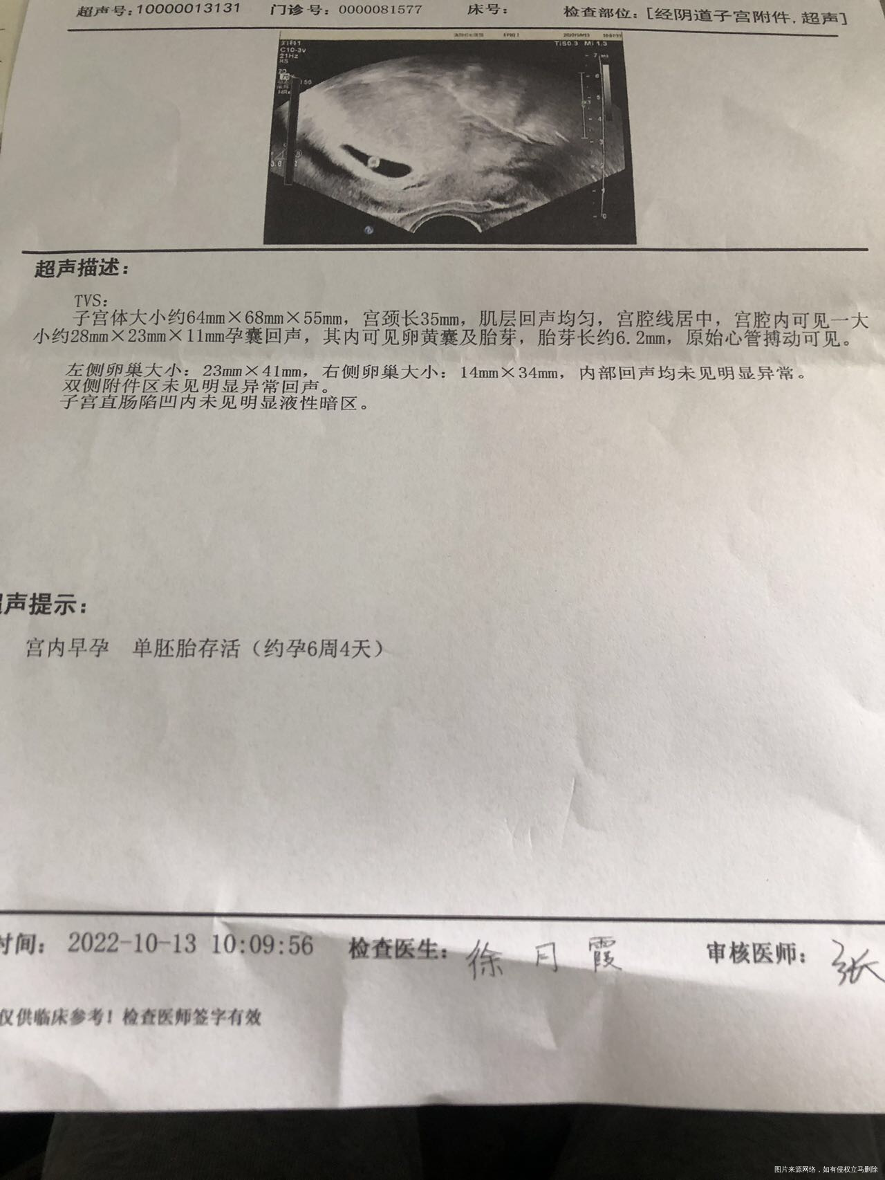 今天做b超测了胎心胎芽孕囊和胎芽属于正常大小