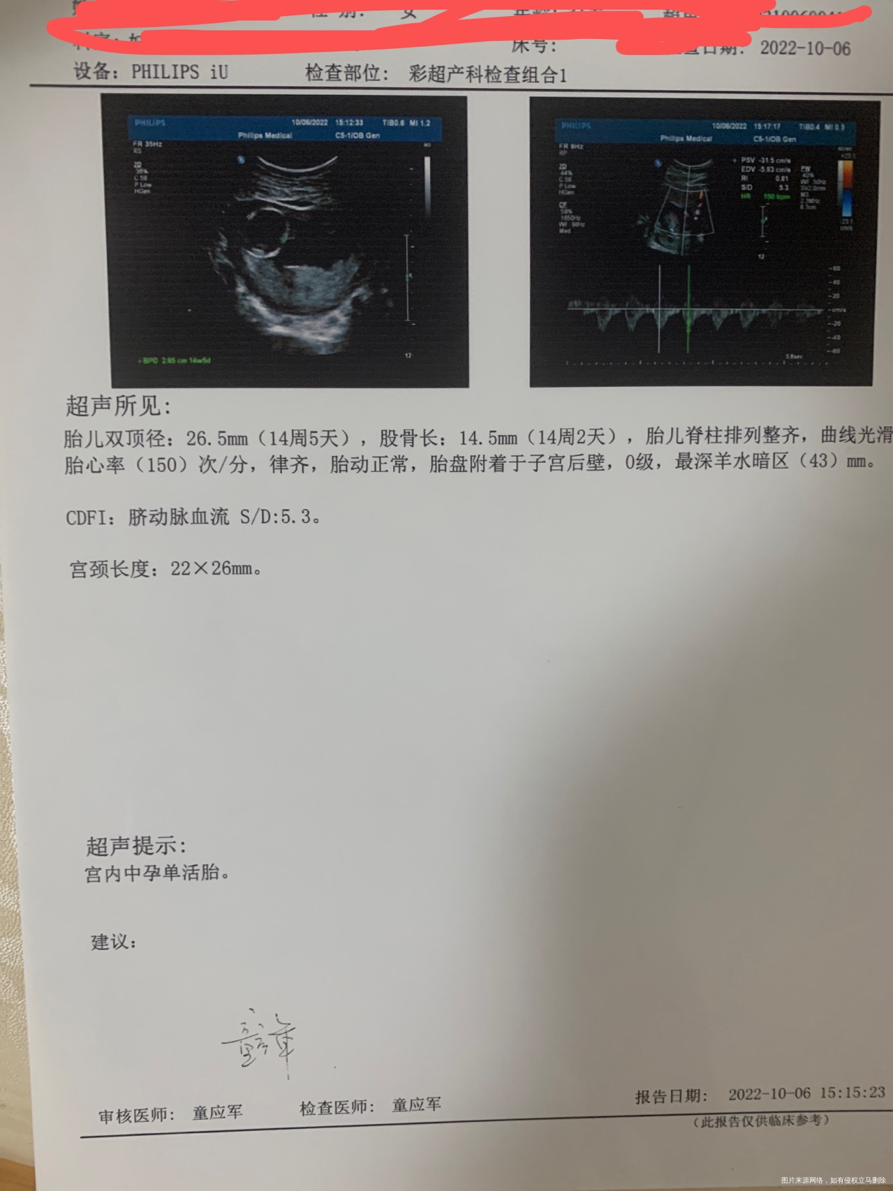 我是做的试管我现在孕14周今天我去医院做了b