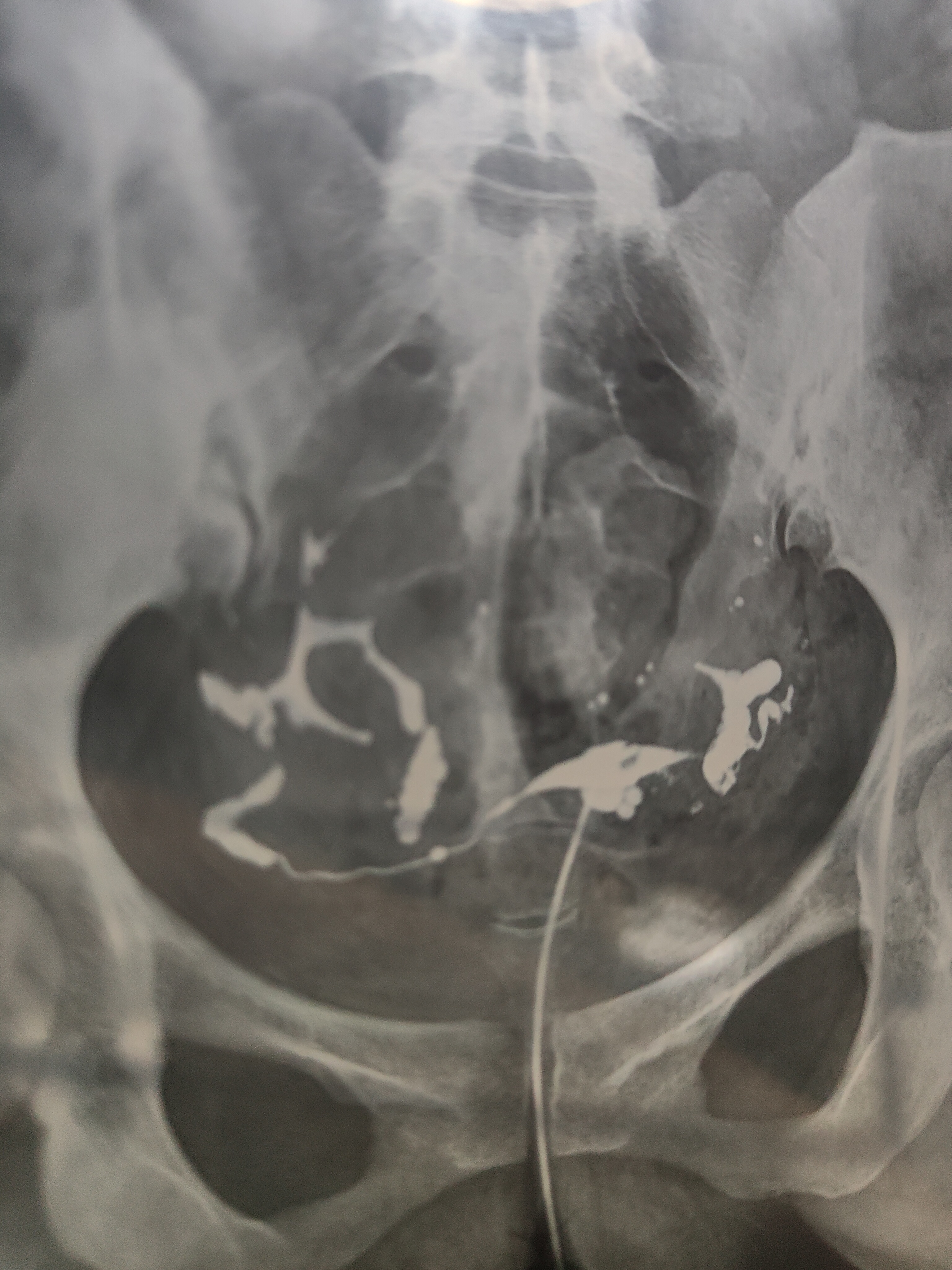 各位医生好前天做了输卵管造影请帮忙看看这些造