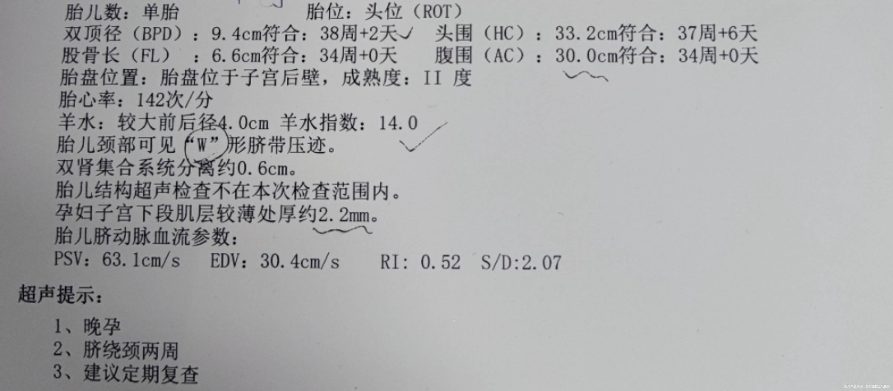 现在35周能到足月吗那么薄绕颈2周能有事吗