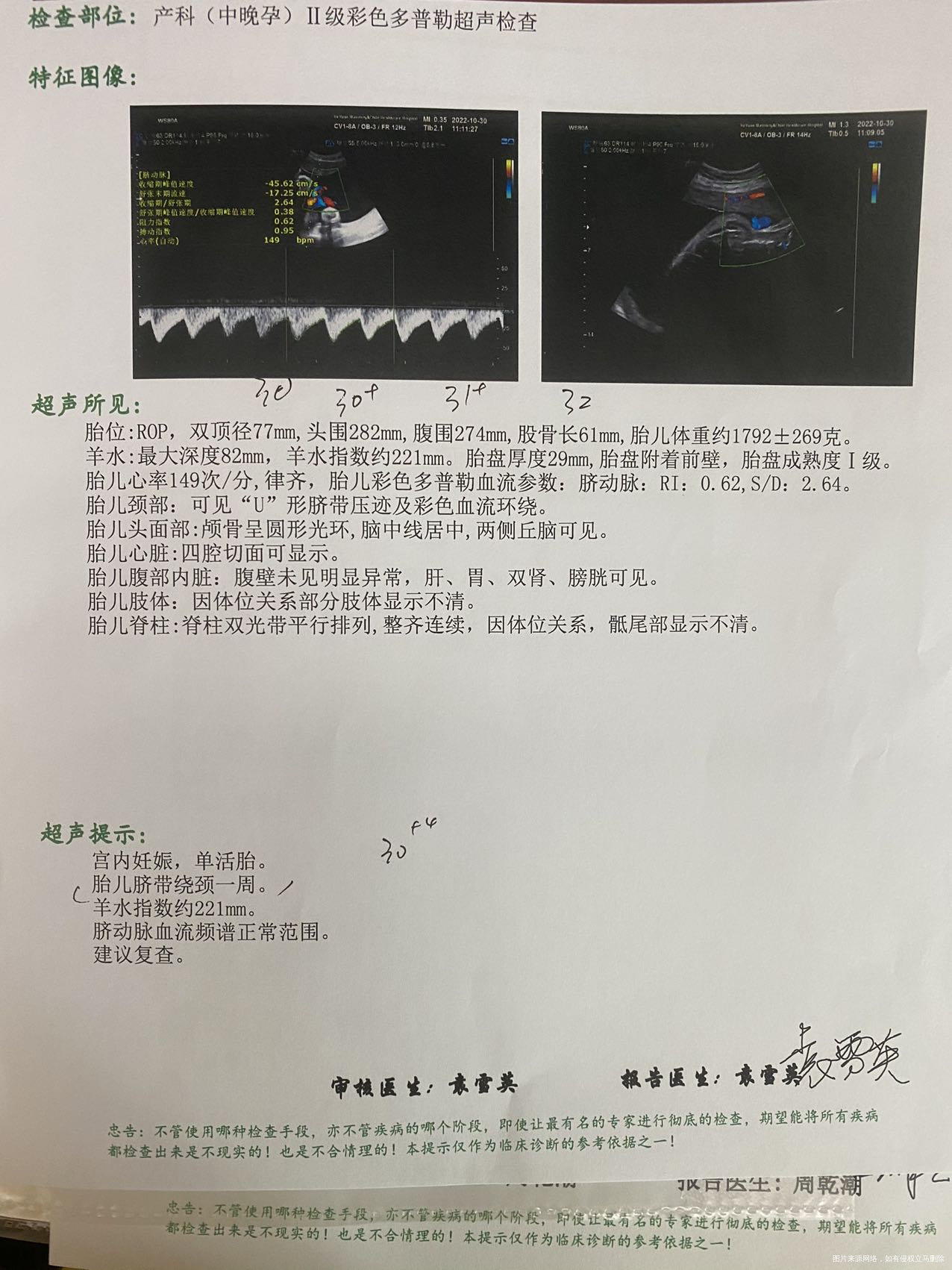 1030号做了常规的b超看着羊水过多但医生说