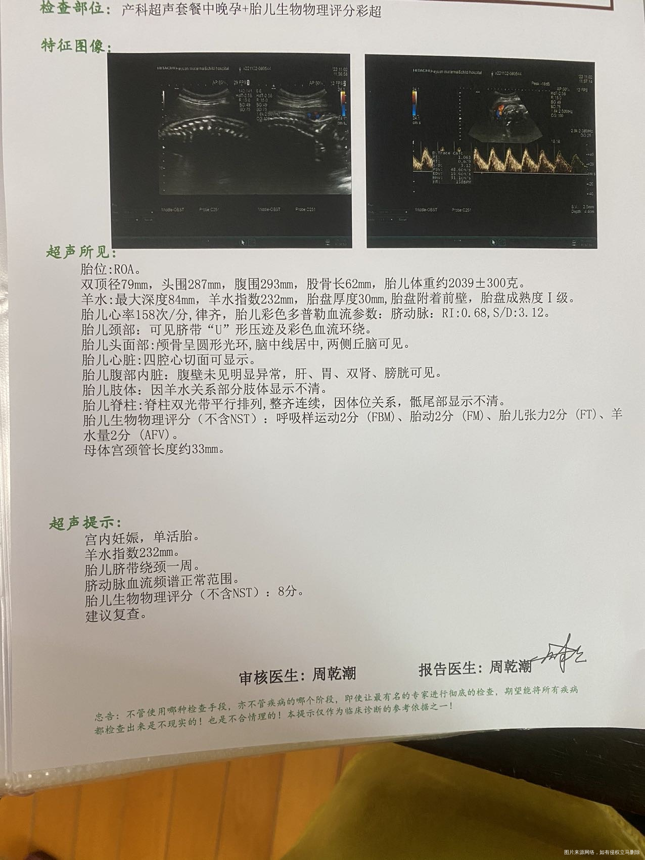 1030号做了常规的b超看着羊水过多但医生说