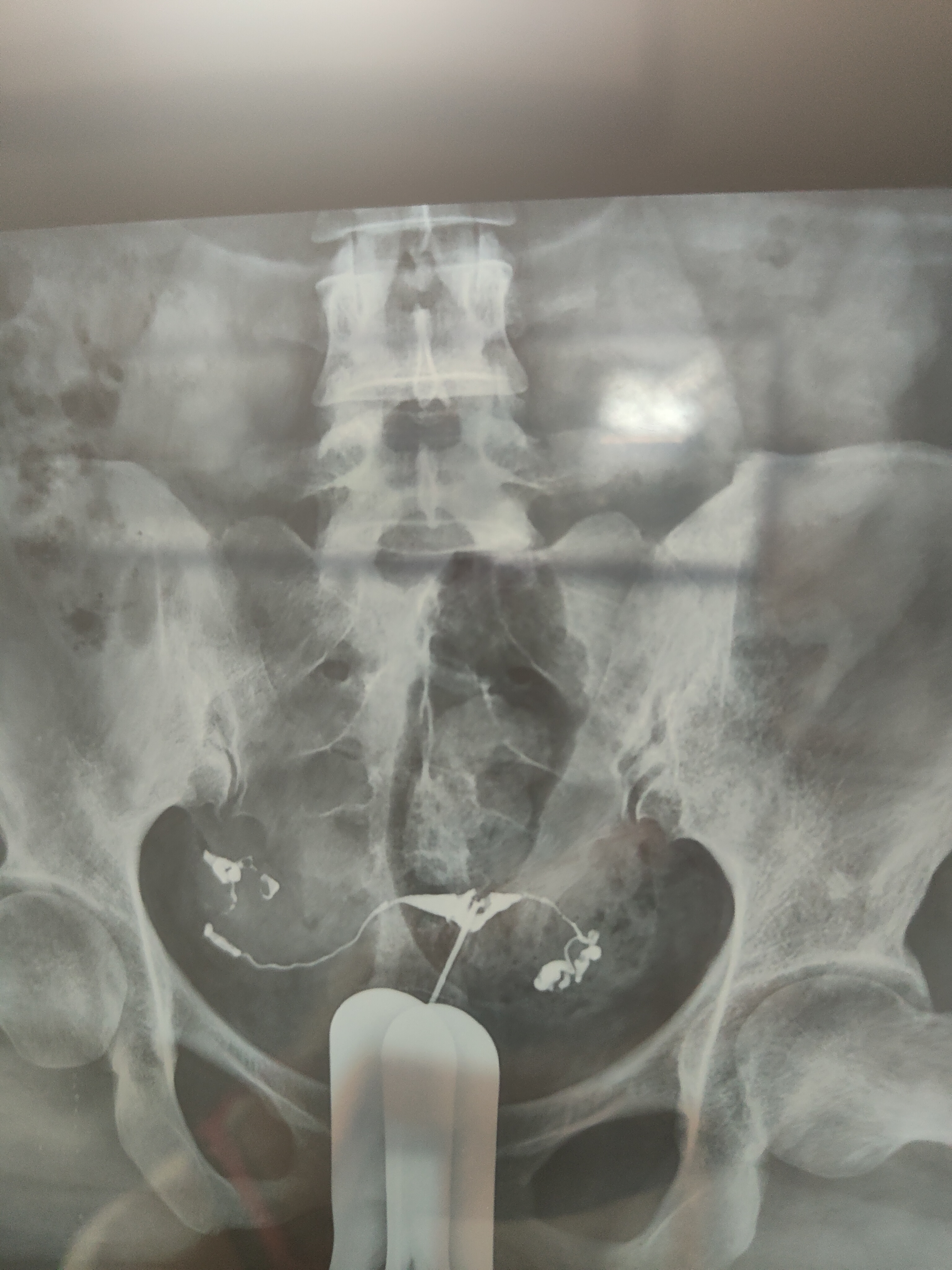 各位医生好前天做了输卵管造影请帮忙看看这些造