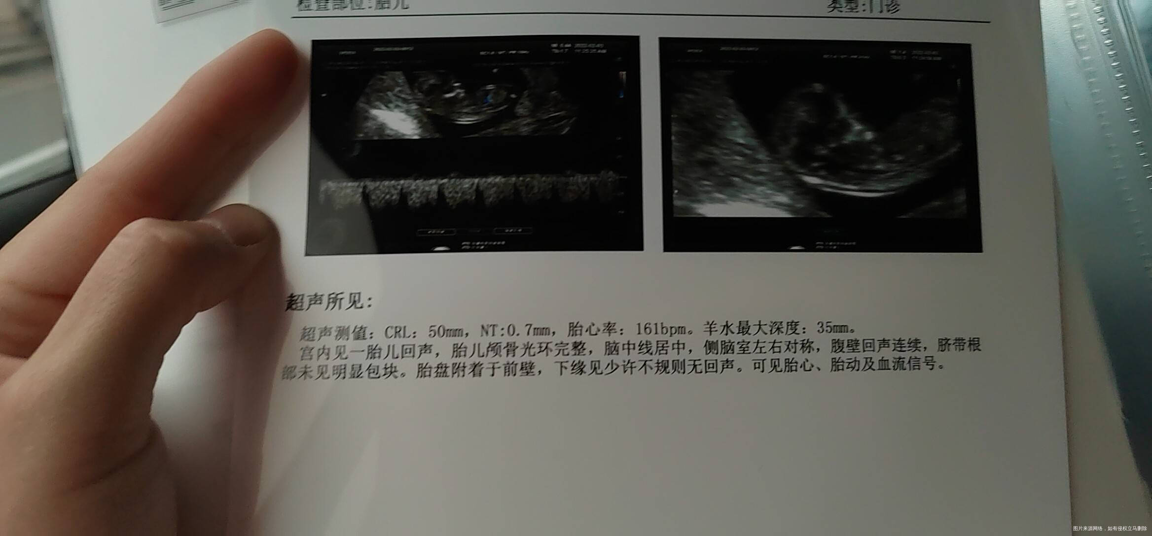 孕11周+5天今天做nt了下缘见少许不规则无