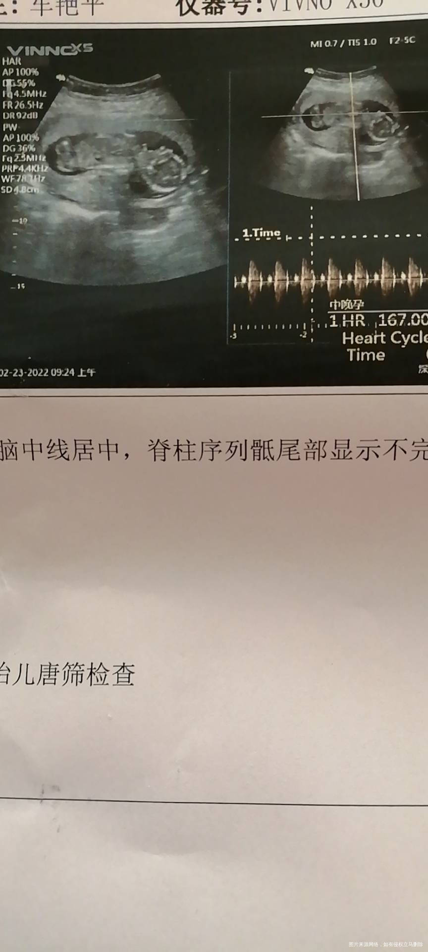 14+5麻烦看一下b超图片孩儿这个姿势咋回事