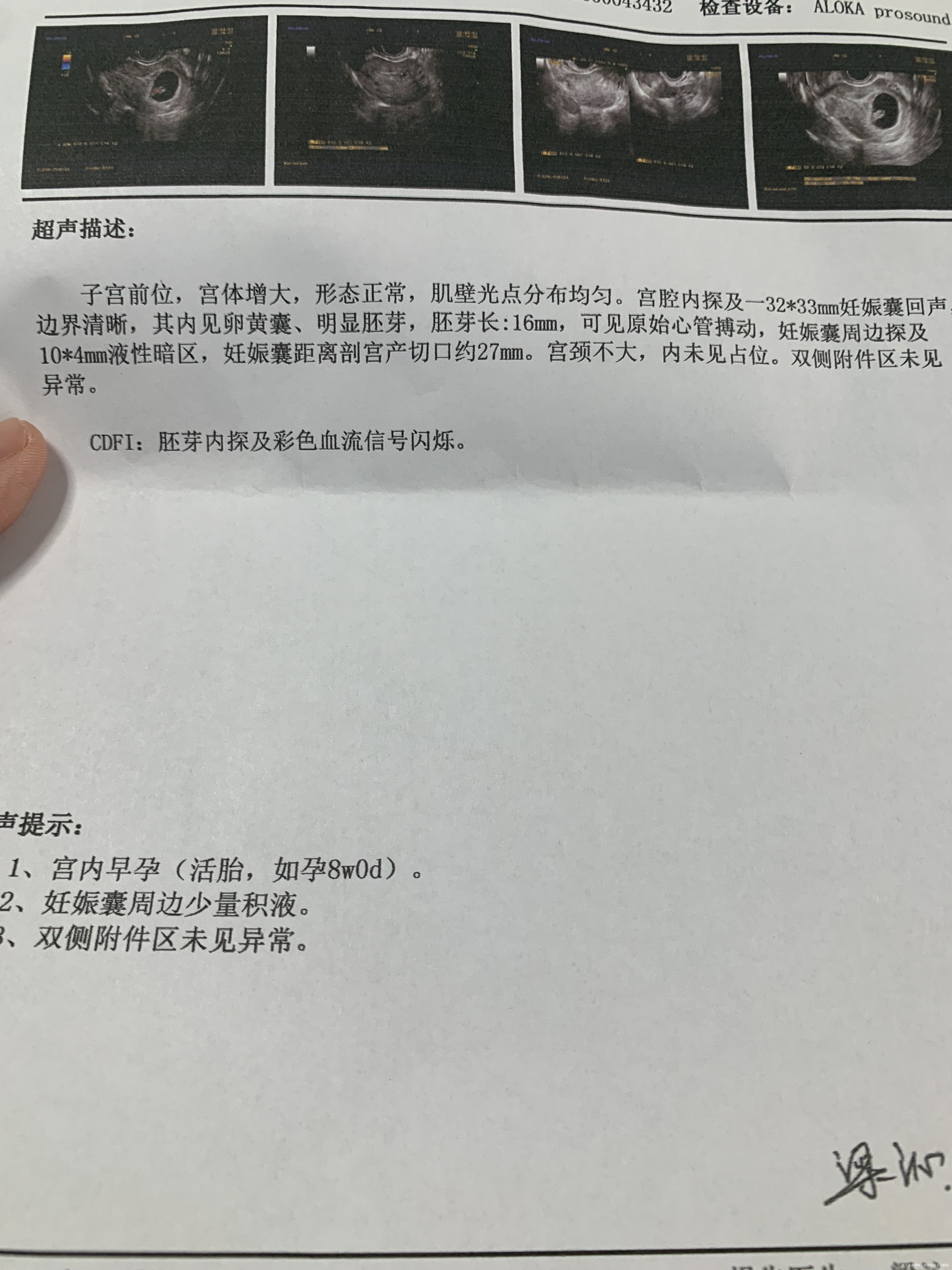 妊娠囊周围有积液怎么办会流产吗