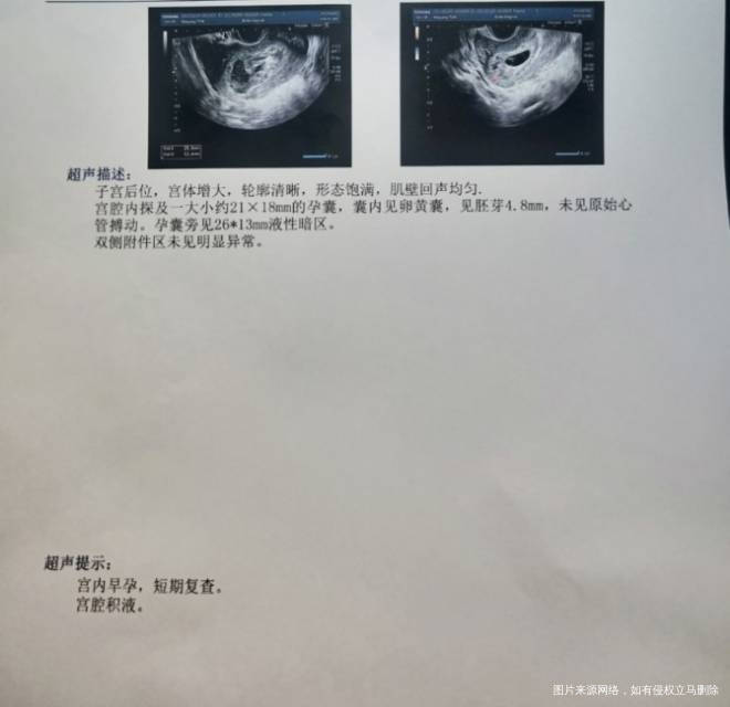 孕8周4天阴超提示有胎芽没有胎心七周4天的时