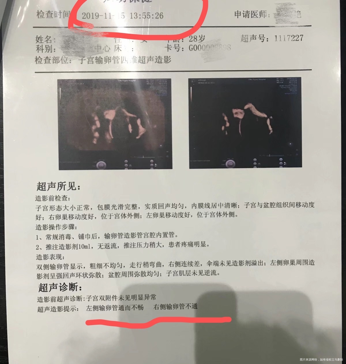 除了再做一次造影外还有其他的检查建议吗