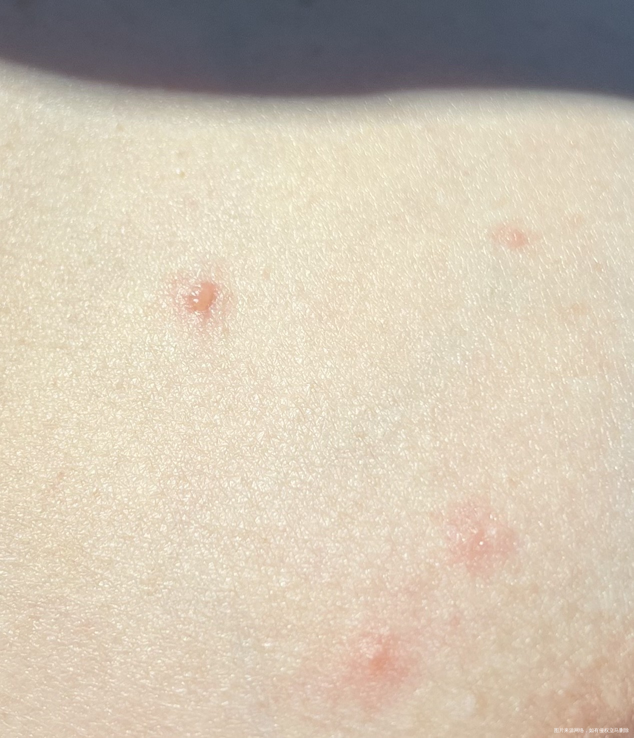 身上起了这种痘痘想问是怎么回事麻烦啦