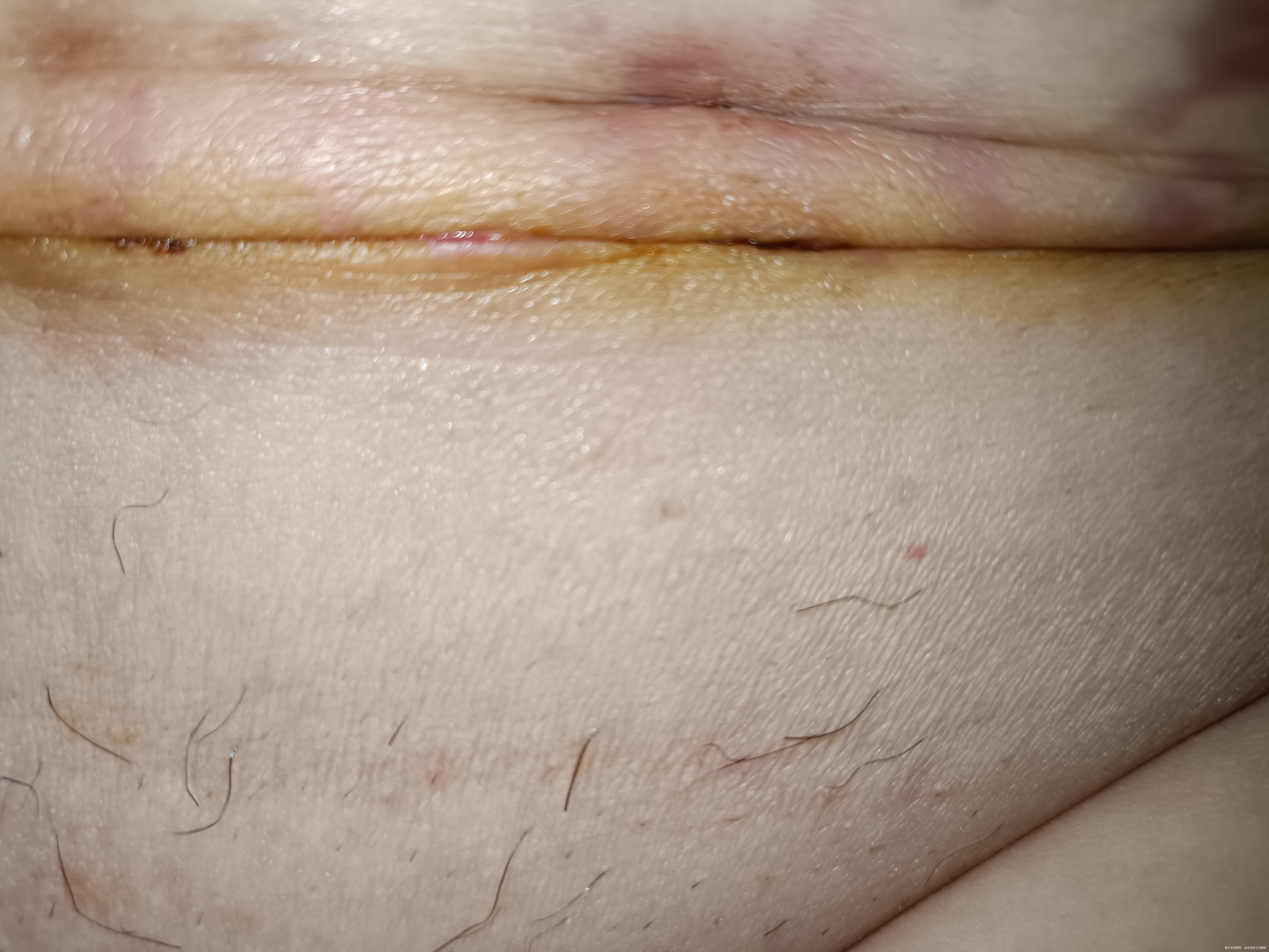 剖腹产24天刀口有点儿小缝隙会不会裂开