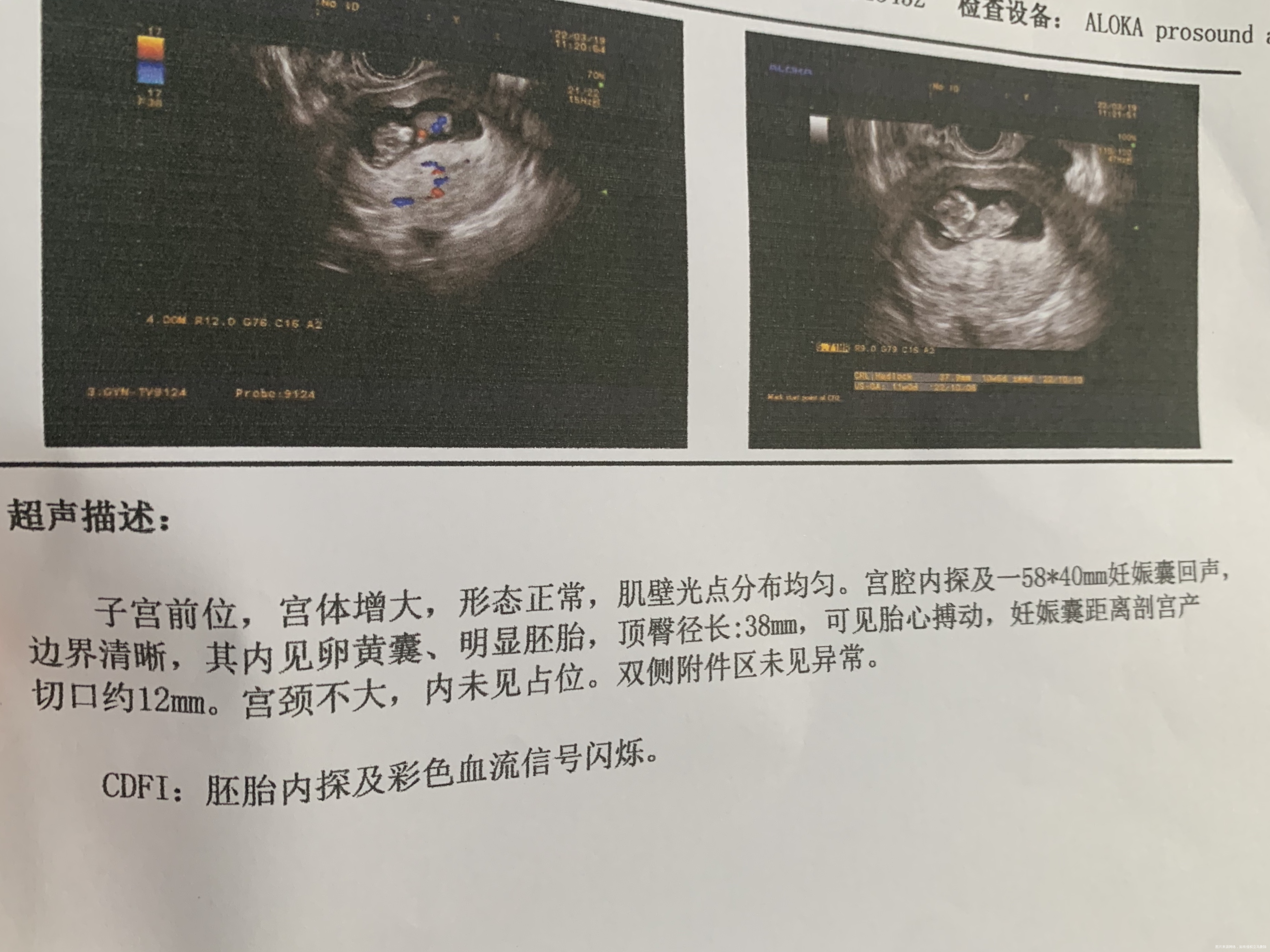 10周5天了这是胎儿成型了吗顶臂长38是什么