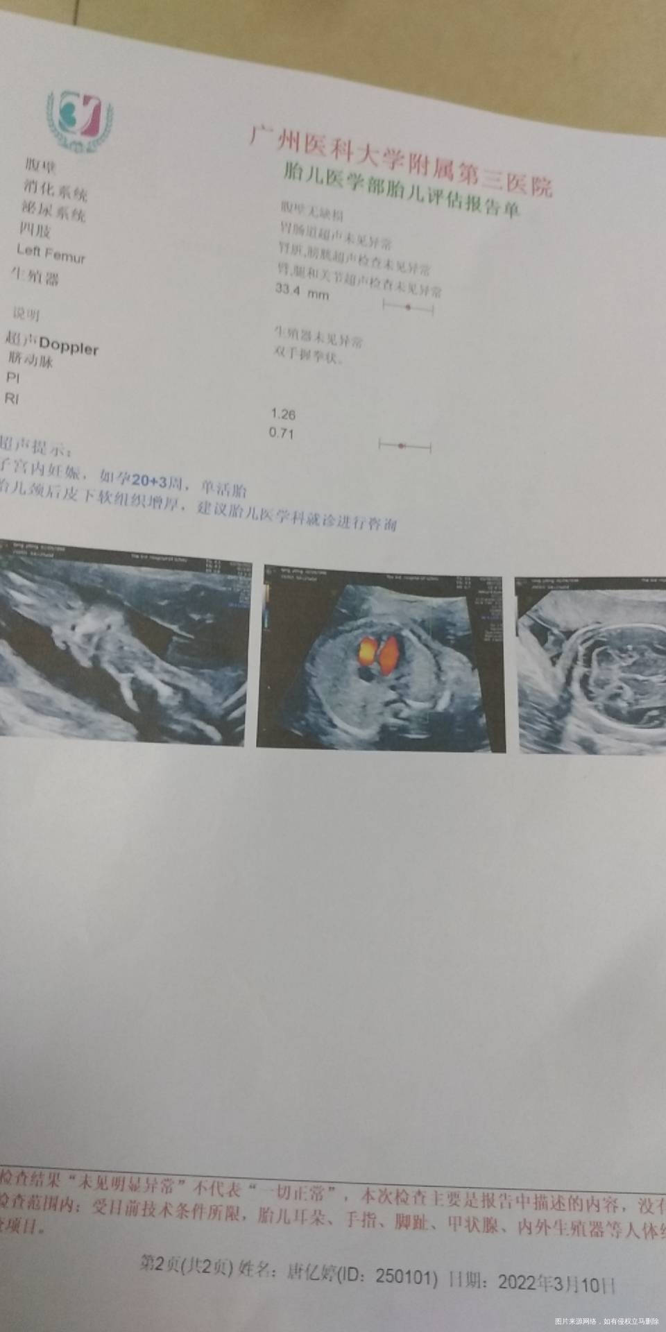 13周做Nt363341然后做了绒毛穿刺结果