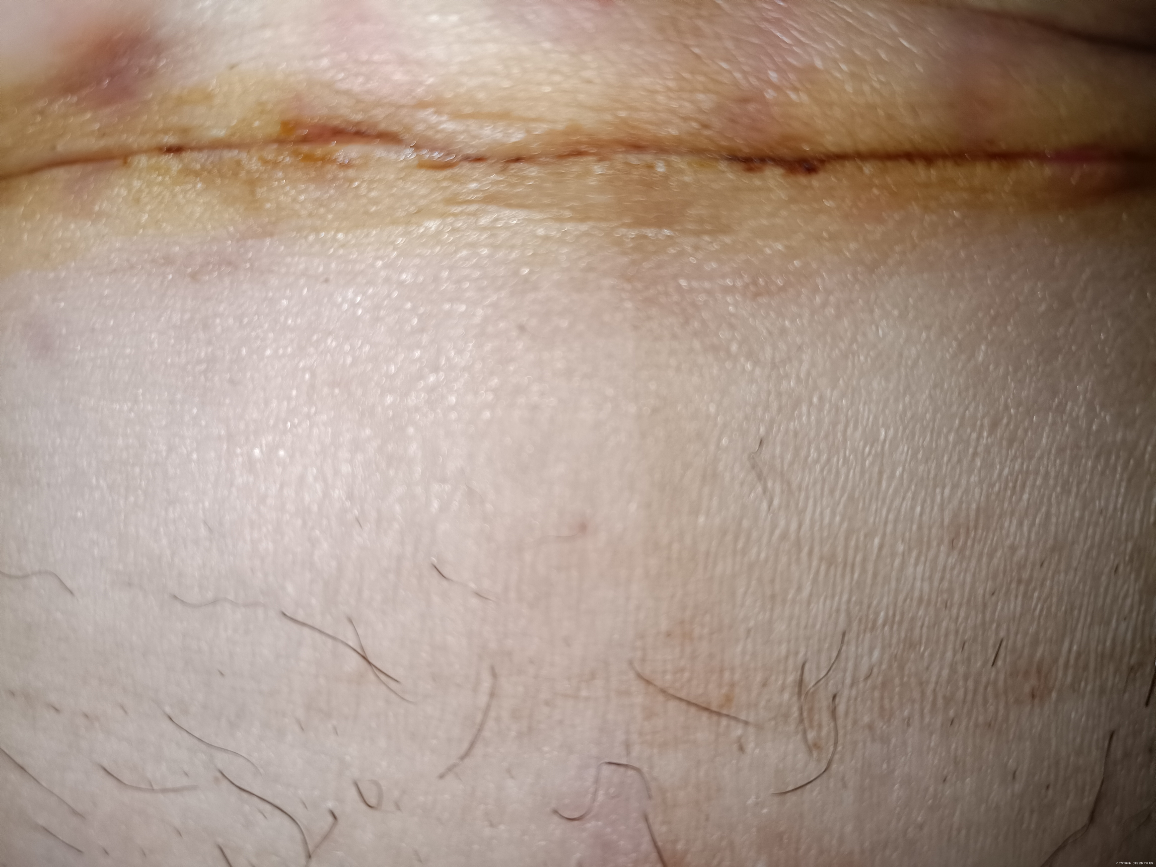 剖腹产24天刀口有点儿小缝隙会不会裂开