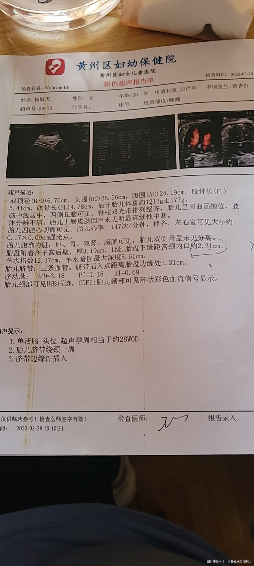 请帮我看看脐带绕颈一圈还有小排畸结果和强光点