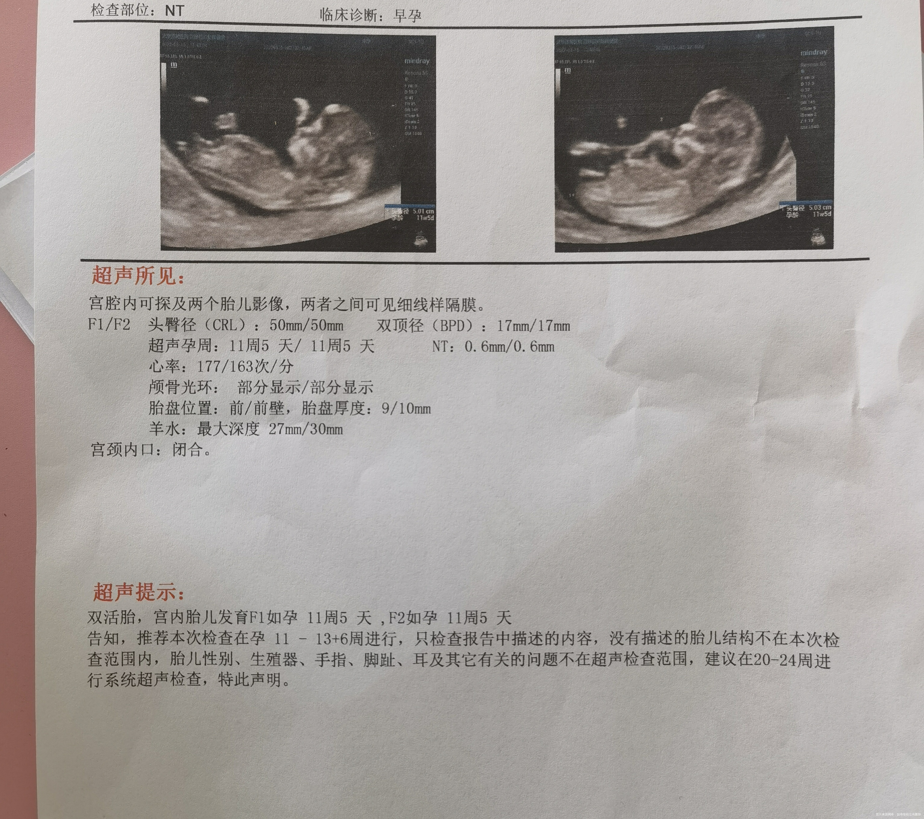 医生您好孕11周➕5做的NT之前孕酮低一直在