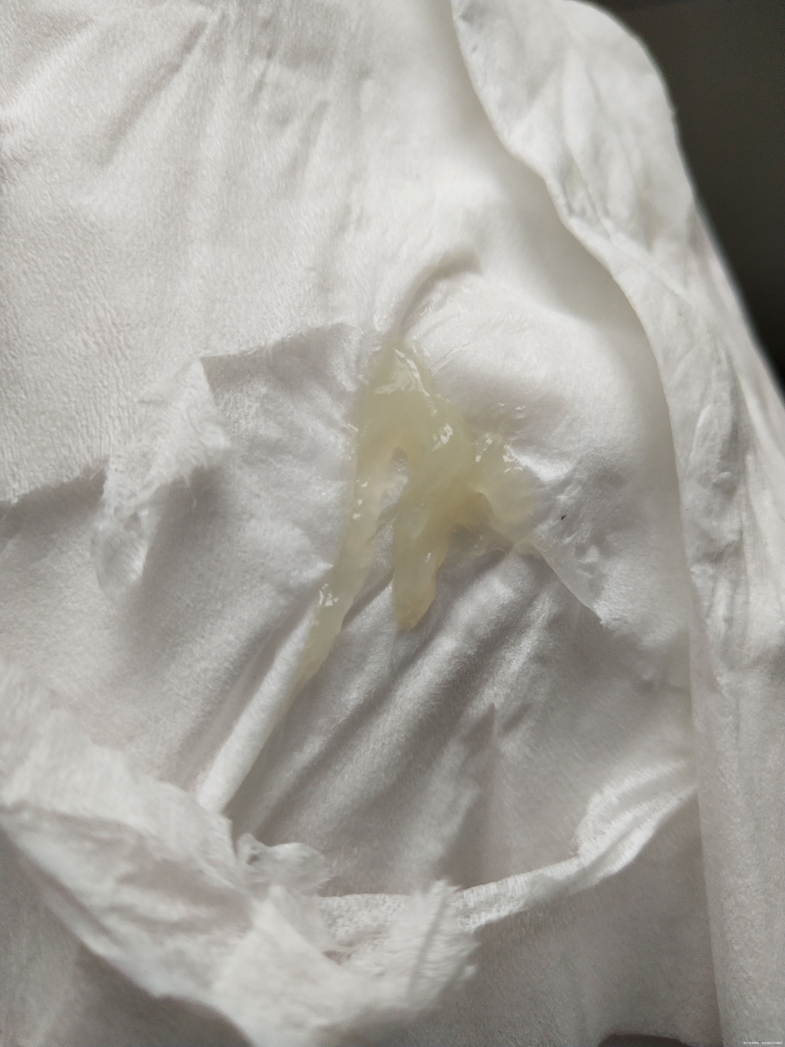 现孕36周13周做了预防性宫颈环扎现未拆线今