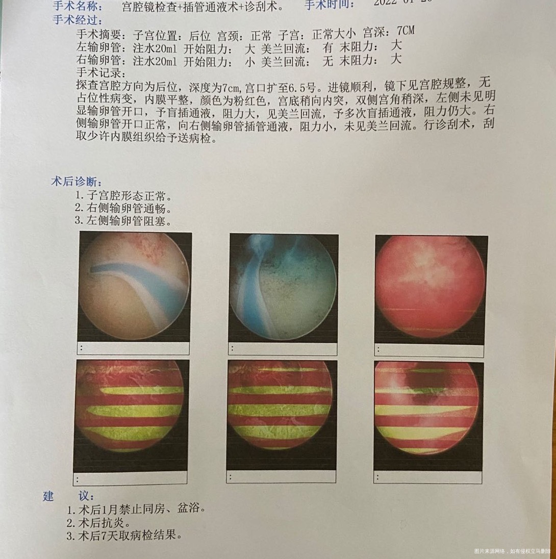 多囊左侧输卵管堵塞3月17号月经第九天去监测