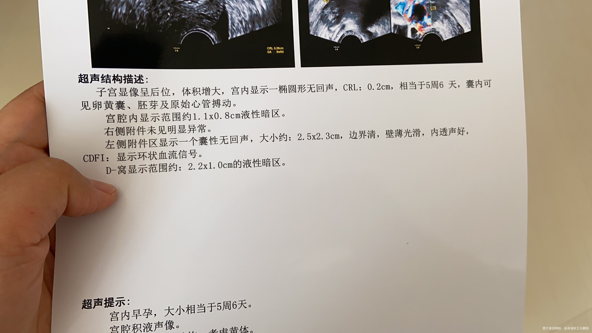 多囊胎停史怀孕5周6天有积液正常吗打了脂肪乳