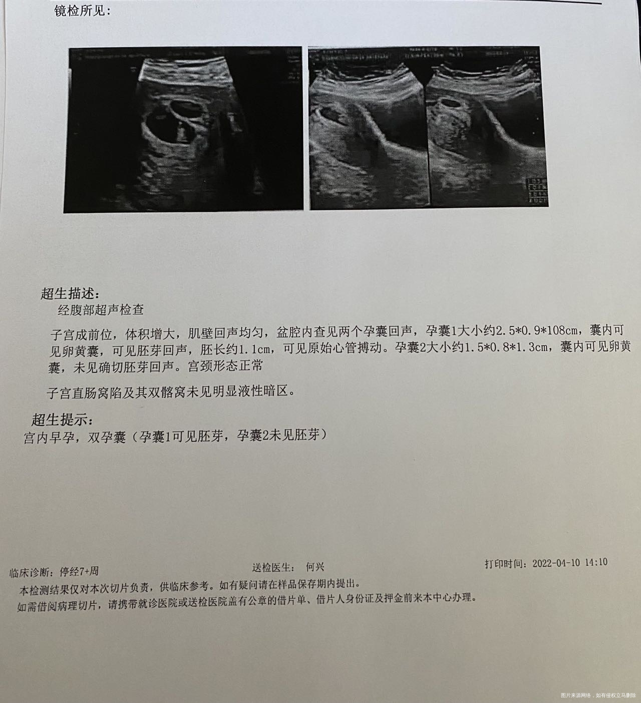 大夫您好我是3月7日移植的5天双囊胚4月10